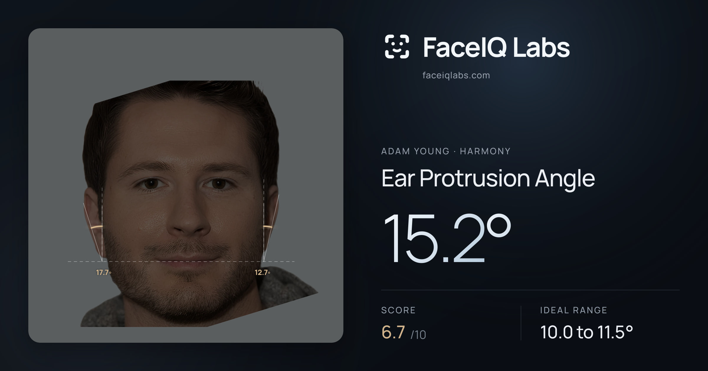 Adam Young Ear Protrusion Angle: 15.2°, drawn on the photo