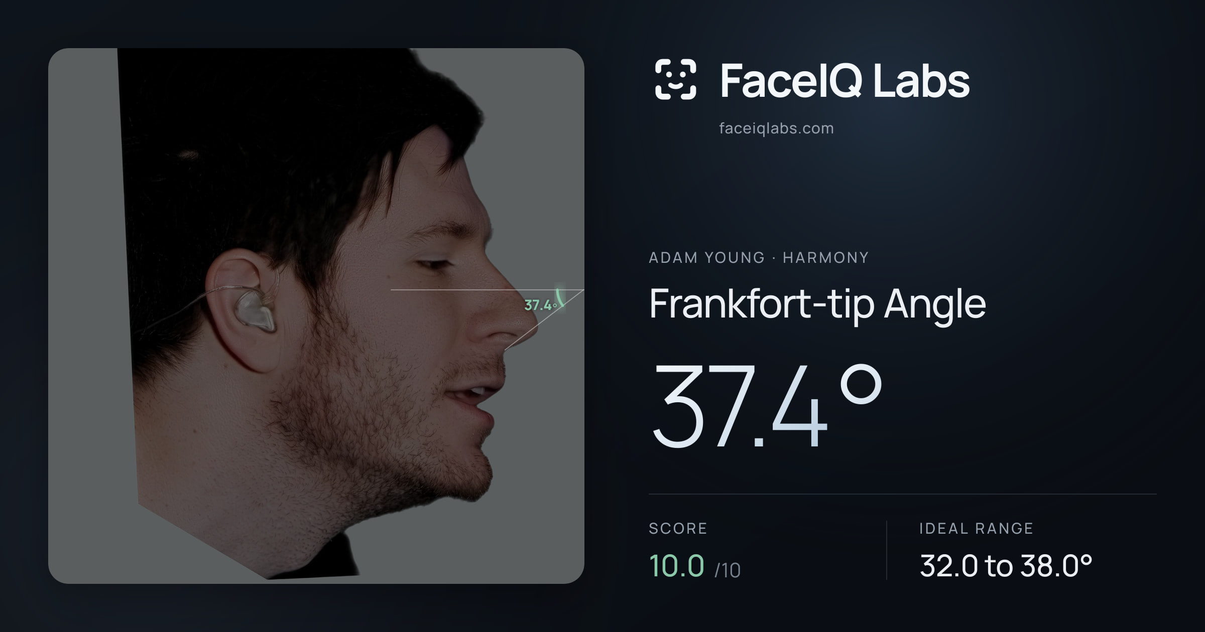Adam Young Frankfort-tip Angle: 37.4°, drawn on the photo
