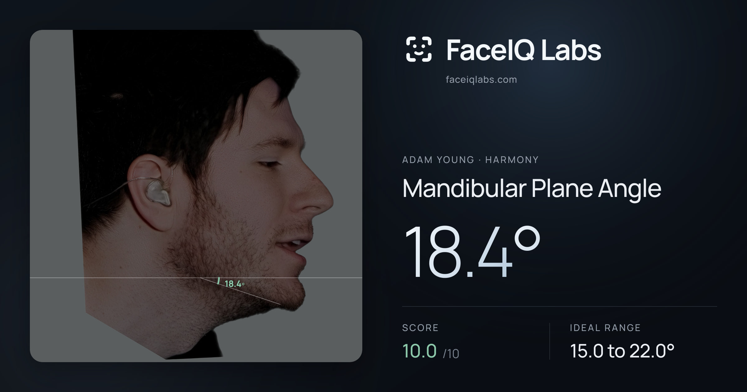 Adam Young Mandibular Plane Angle: 18.4°, drawn on the photo