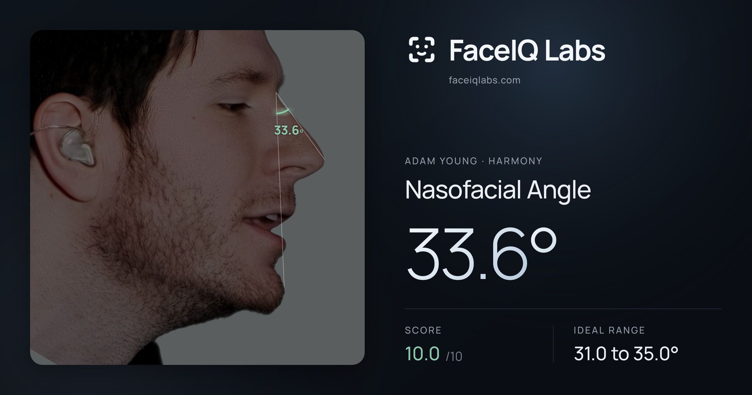 Adam Young Nasofacial Angle: 33.6°, drawn on the photo