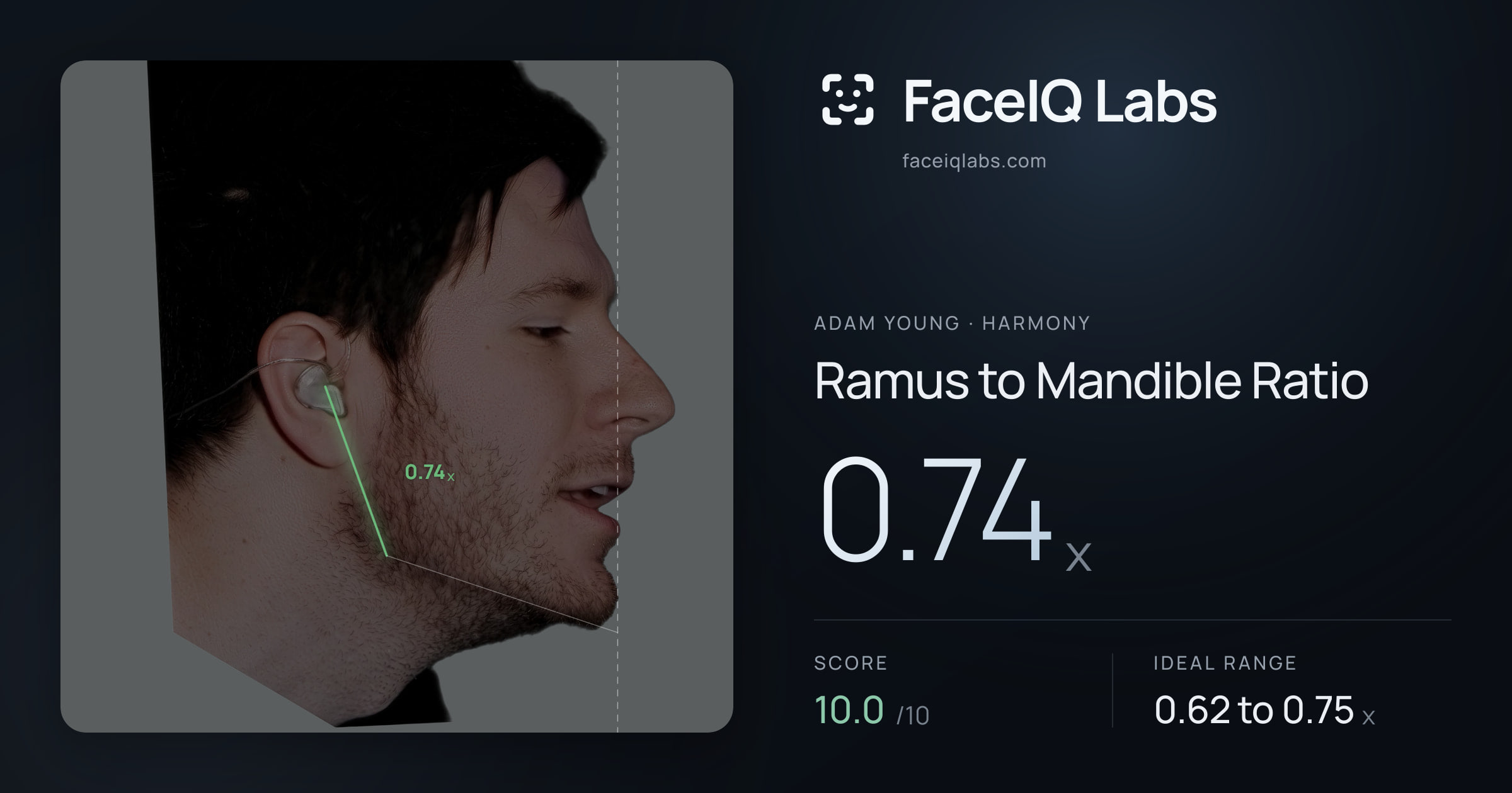 Adam Young Ramus to Mandible Ratio: 0.74x, drawn on the photo
