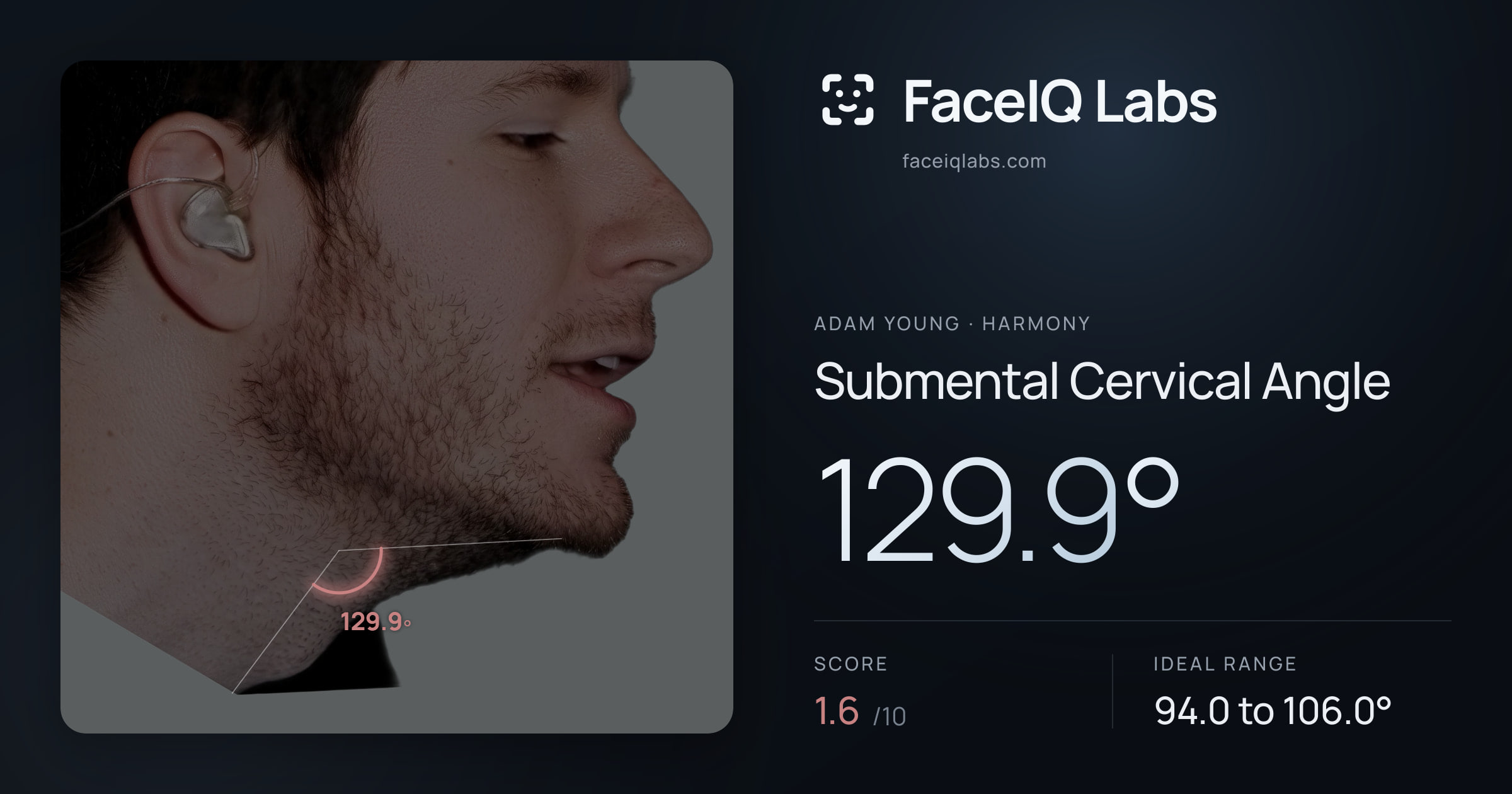 Adam Young Submental Cervical Angle: 129.9°, drawn on the photo