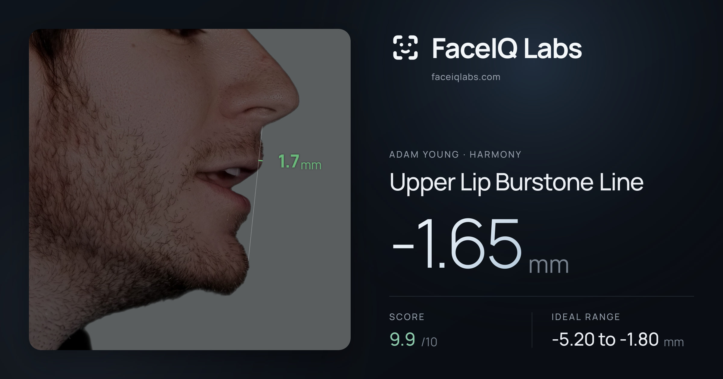 Adam Young Upper Lip Burstone Line: -1.65mm, drawn on the photo