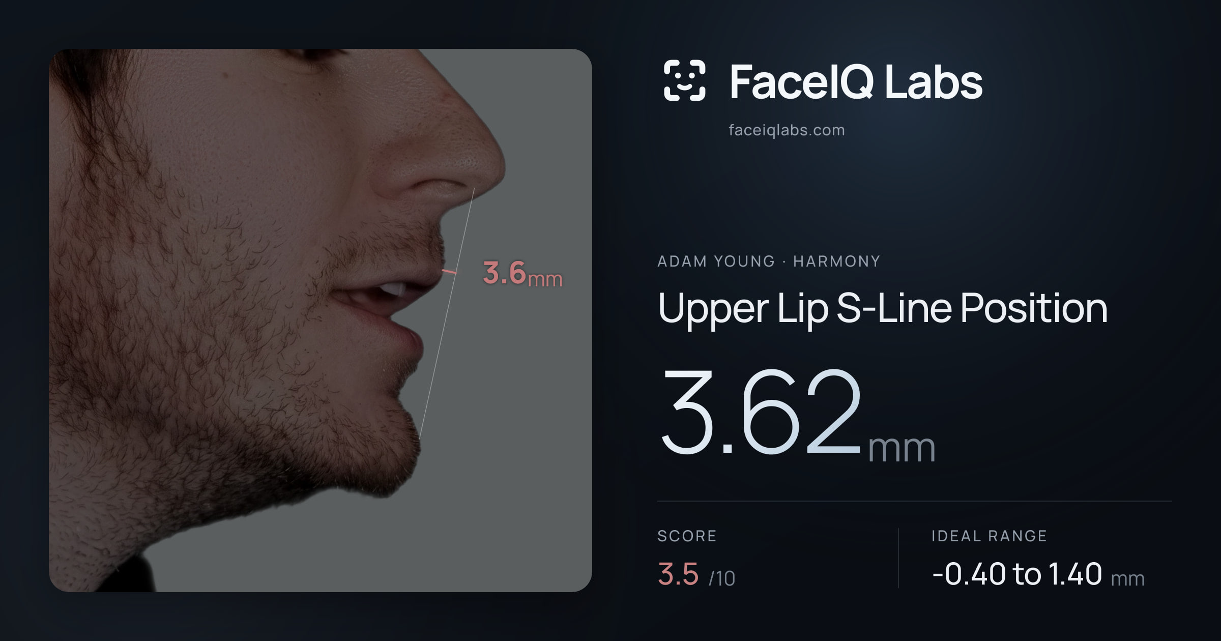 Adam Young Upper Lip S-Line Position: 3.62mm, drawn on the photo