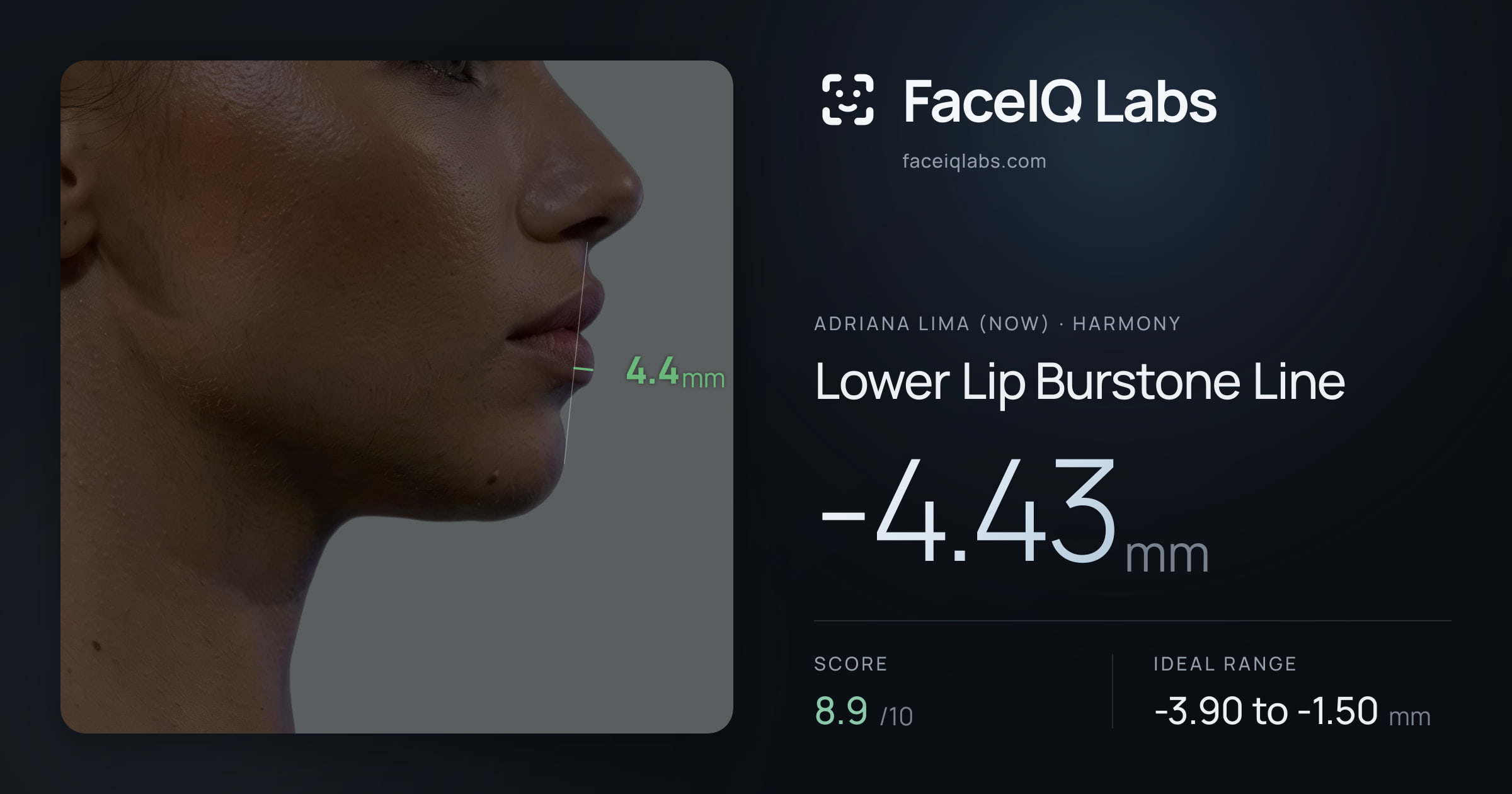 Adriana lima (now) Lower Lip Burstone Line: -4.43mm, drawn on the photo