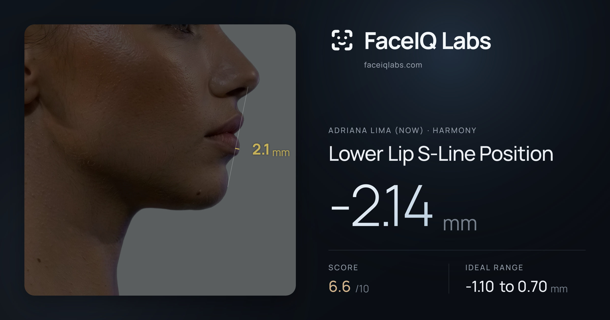 Adriana lima (now) Lower Lip S-Line Position: -2.14mm, drawn on the photo