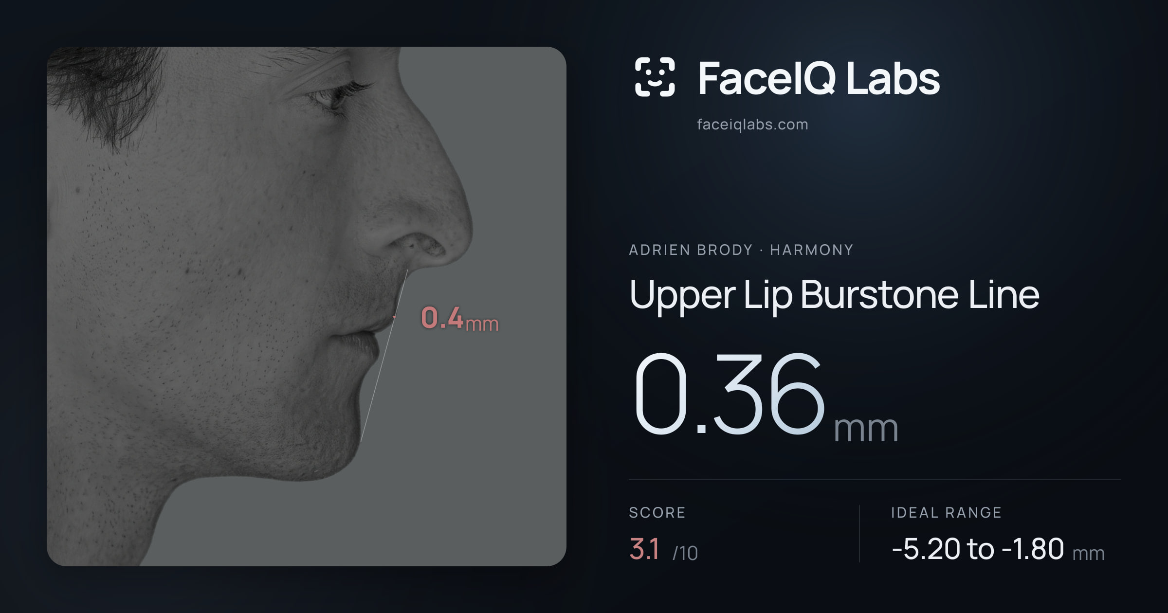 Adrien Brody Upper Lip Burstone Line: 0.36mm, drawn on the photo