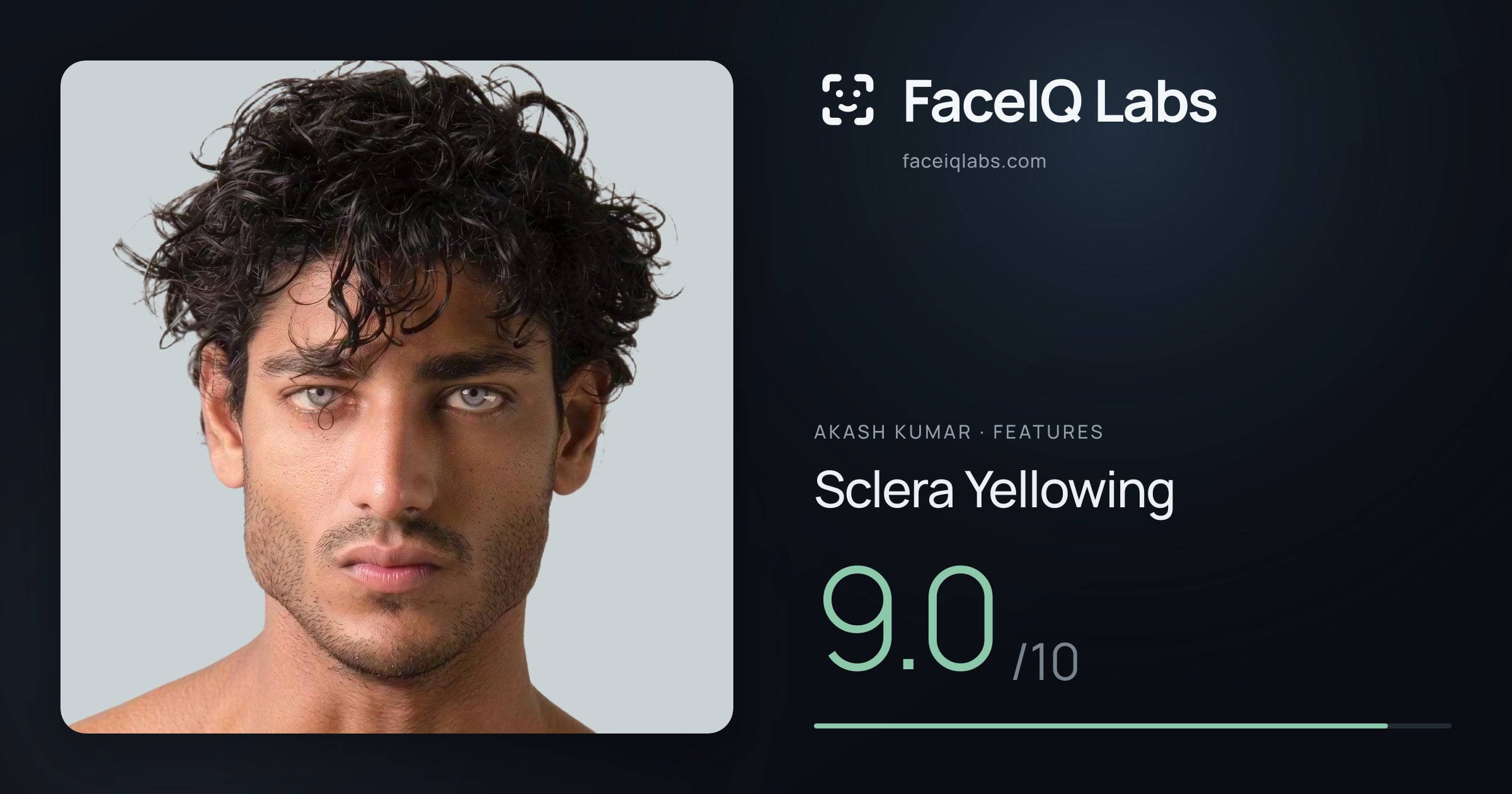 Akash Kumar Sclera Yellowing: 9.0/10, drawn on the photo