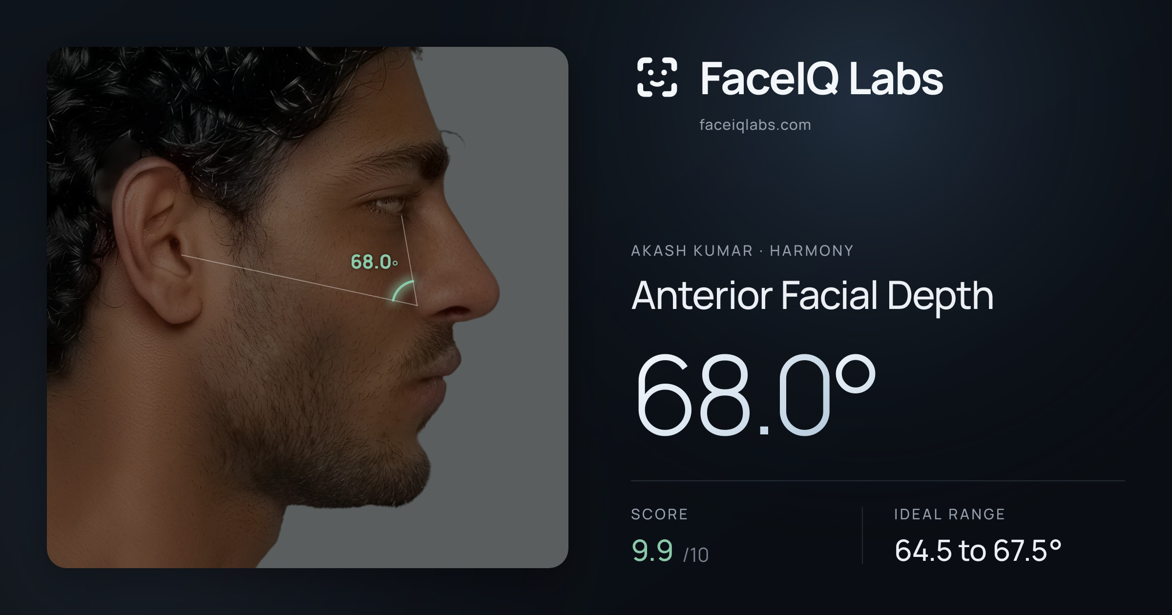 Akash Kumar Anterior Facial Depth: 68.0°, drawn on the photo