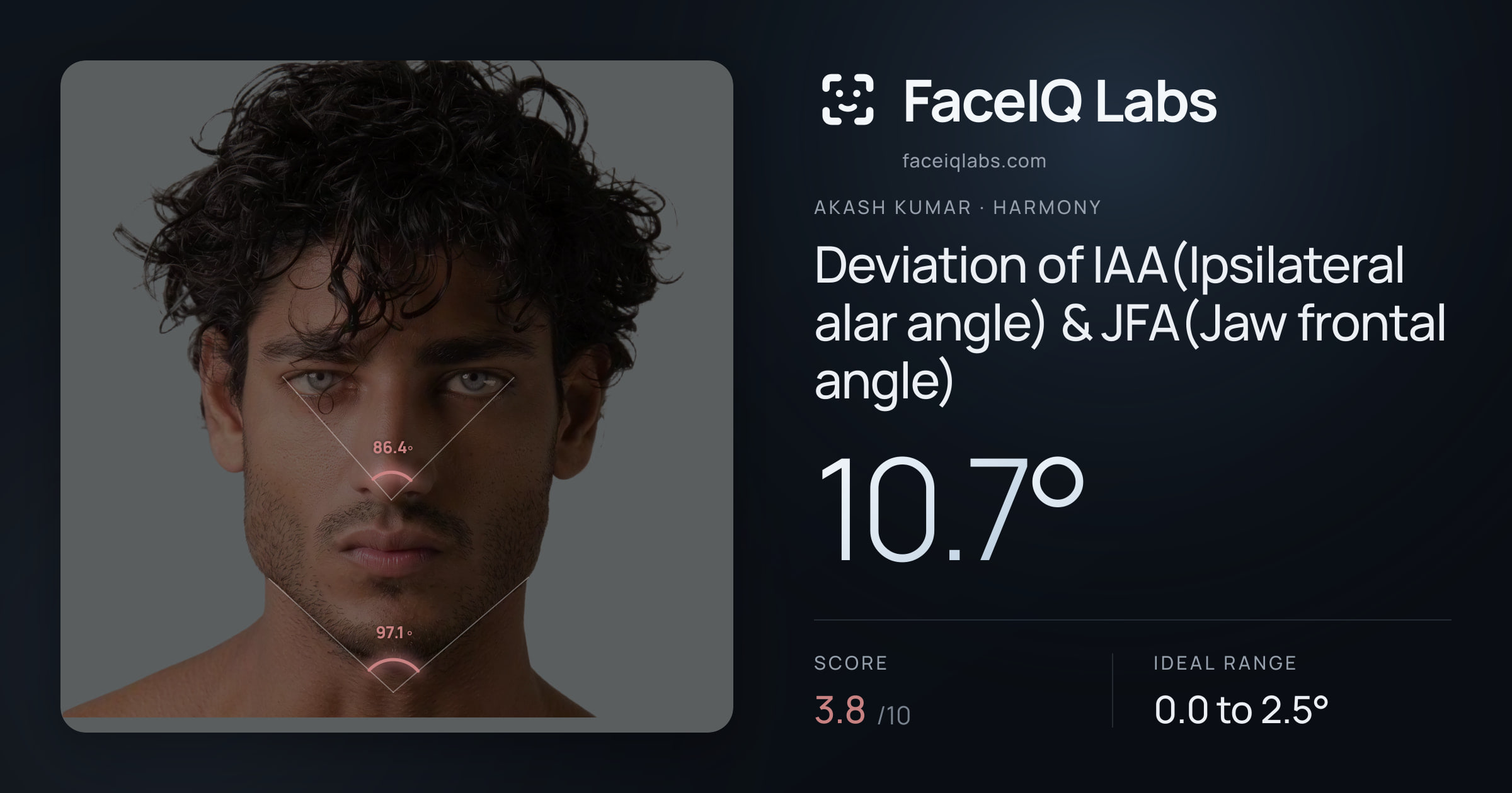 Akash Kumar Deviation of IAA(Ipsilateral alar angle) & JFA(Jaw frontal angle): 10.7°, drawn on the photo