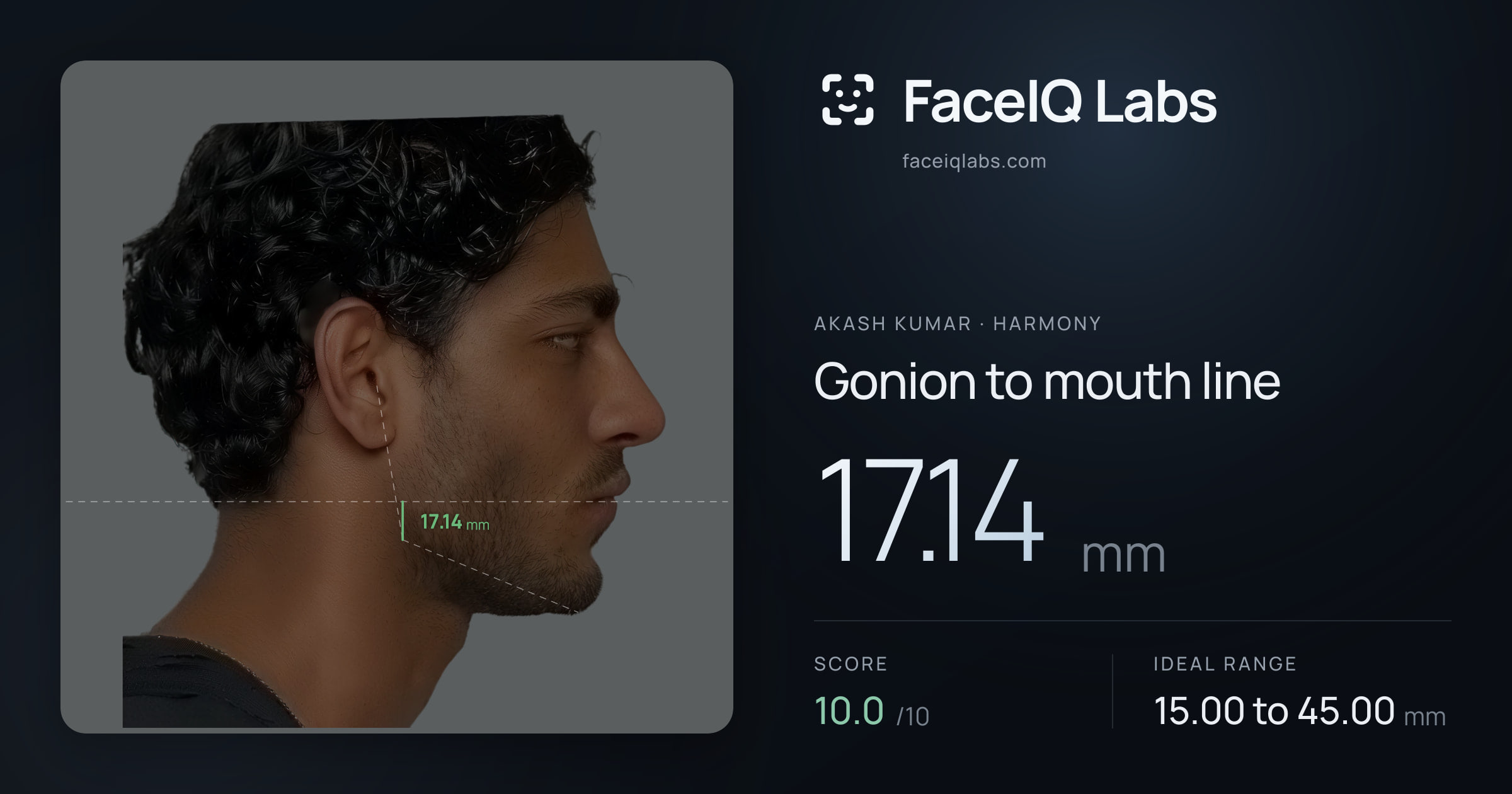 Akash Kumar Gonion to mouth line: 17.14mm, drawn on the photo