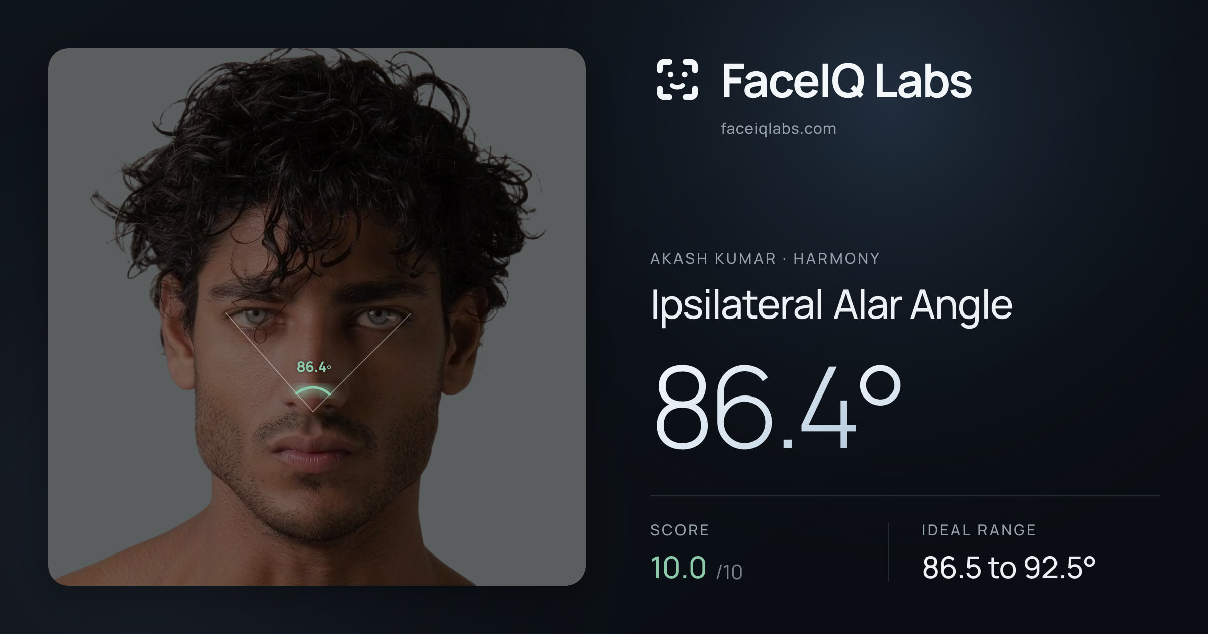 Akash Kumar Ipsilateral Alar Angle: 86.4°, drawn on the photo