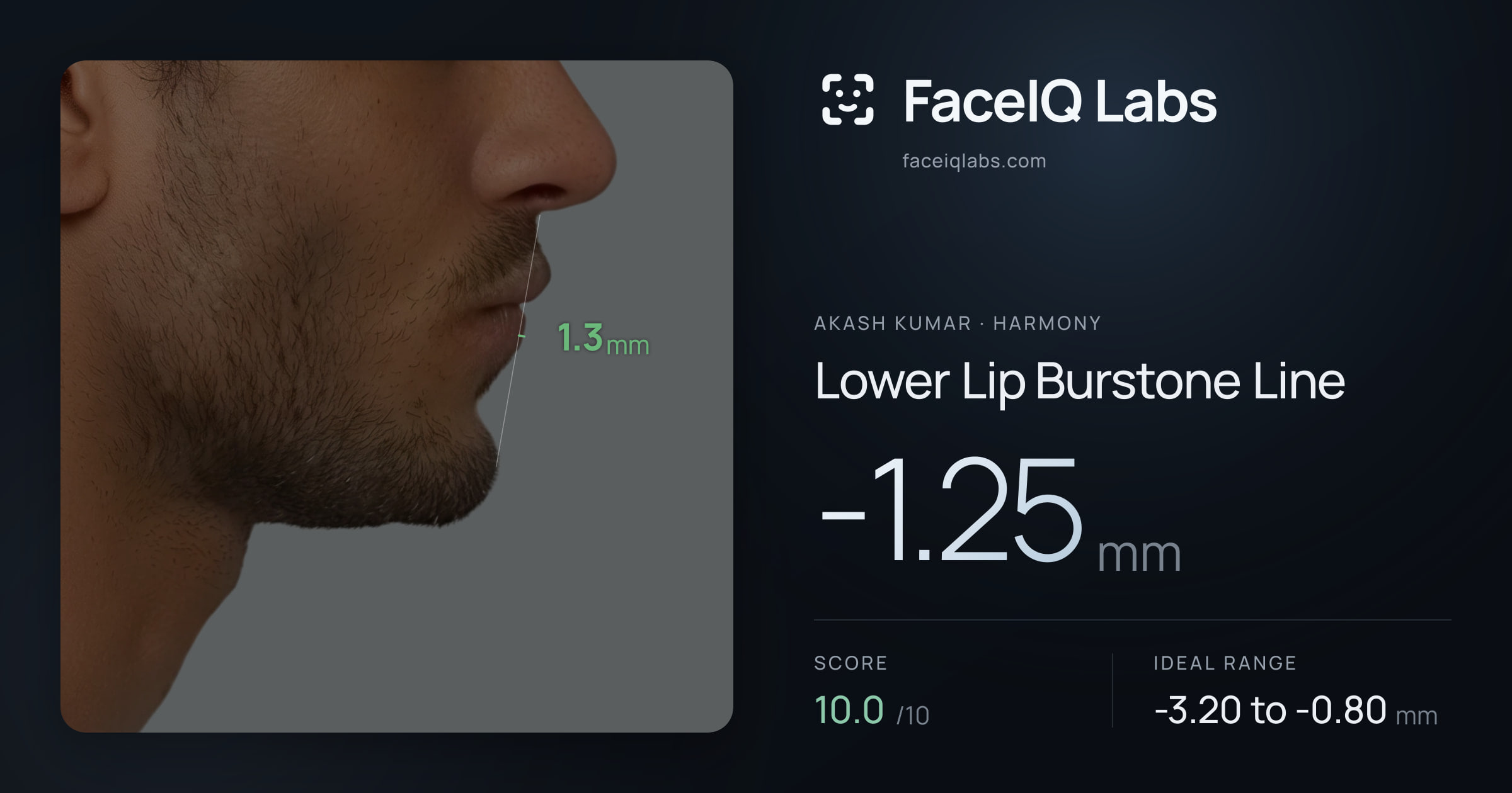 Akash Kumar Lower Lip Burstone Line: -1.25mm, drawn on the photo