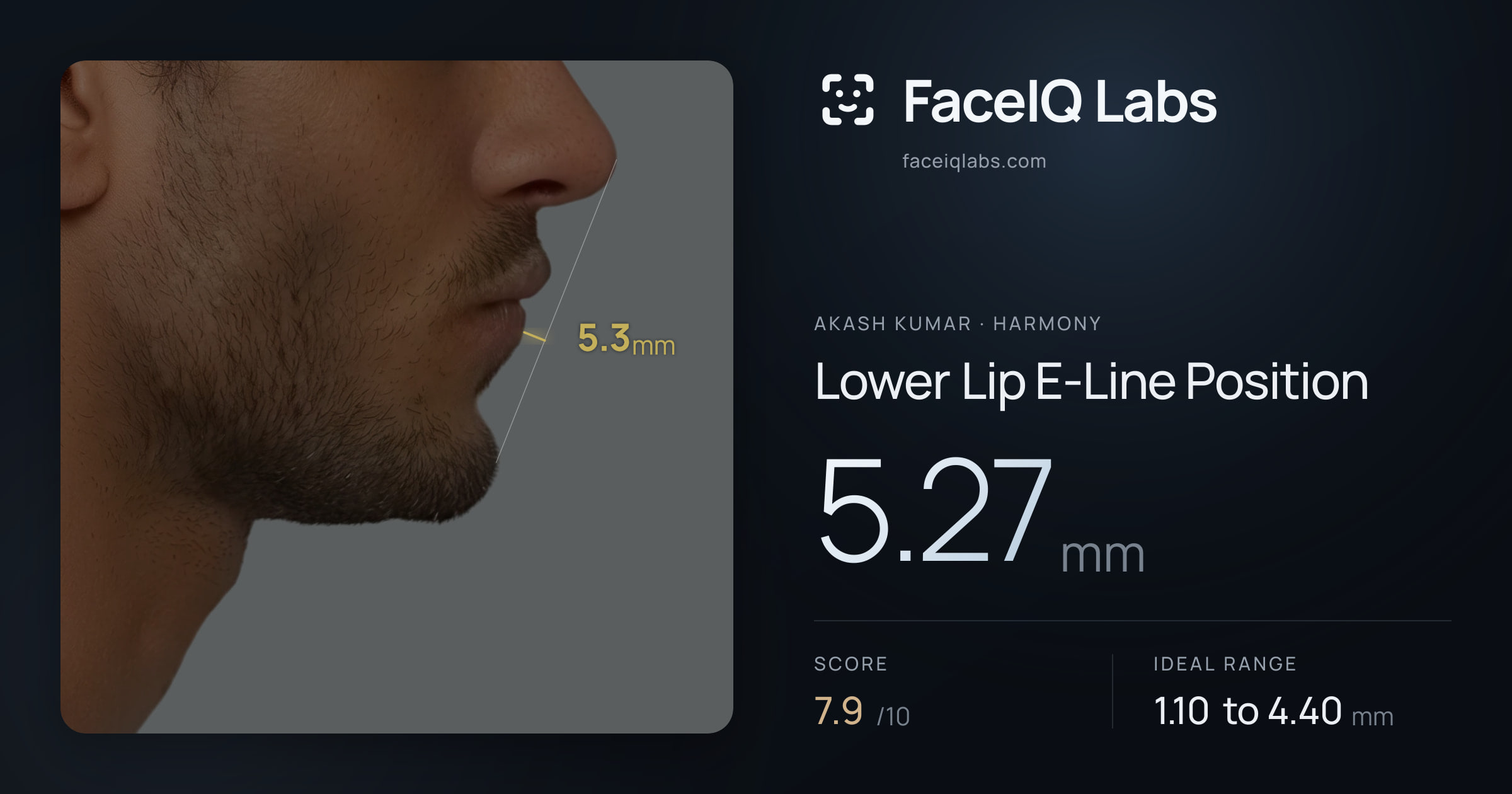 Akash Kumar Lower Lip E-Line Position: 5.27mm, drawn on the photo