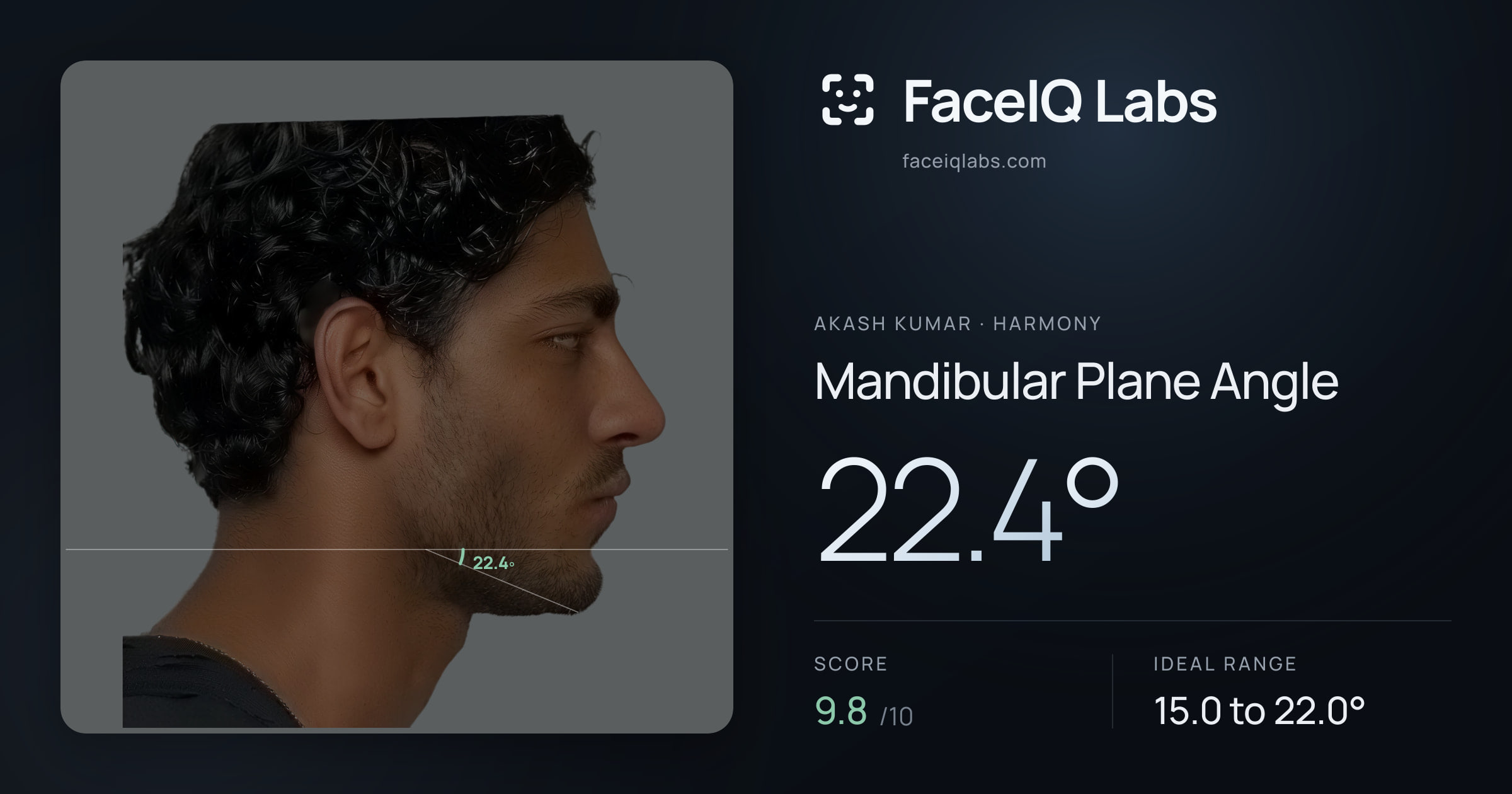 Akash Kumar Mandibular Plane Angle: 22.4°, drawn on the photo