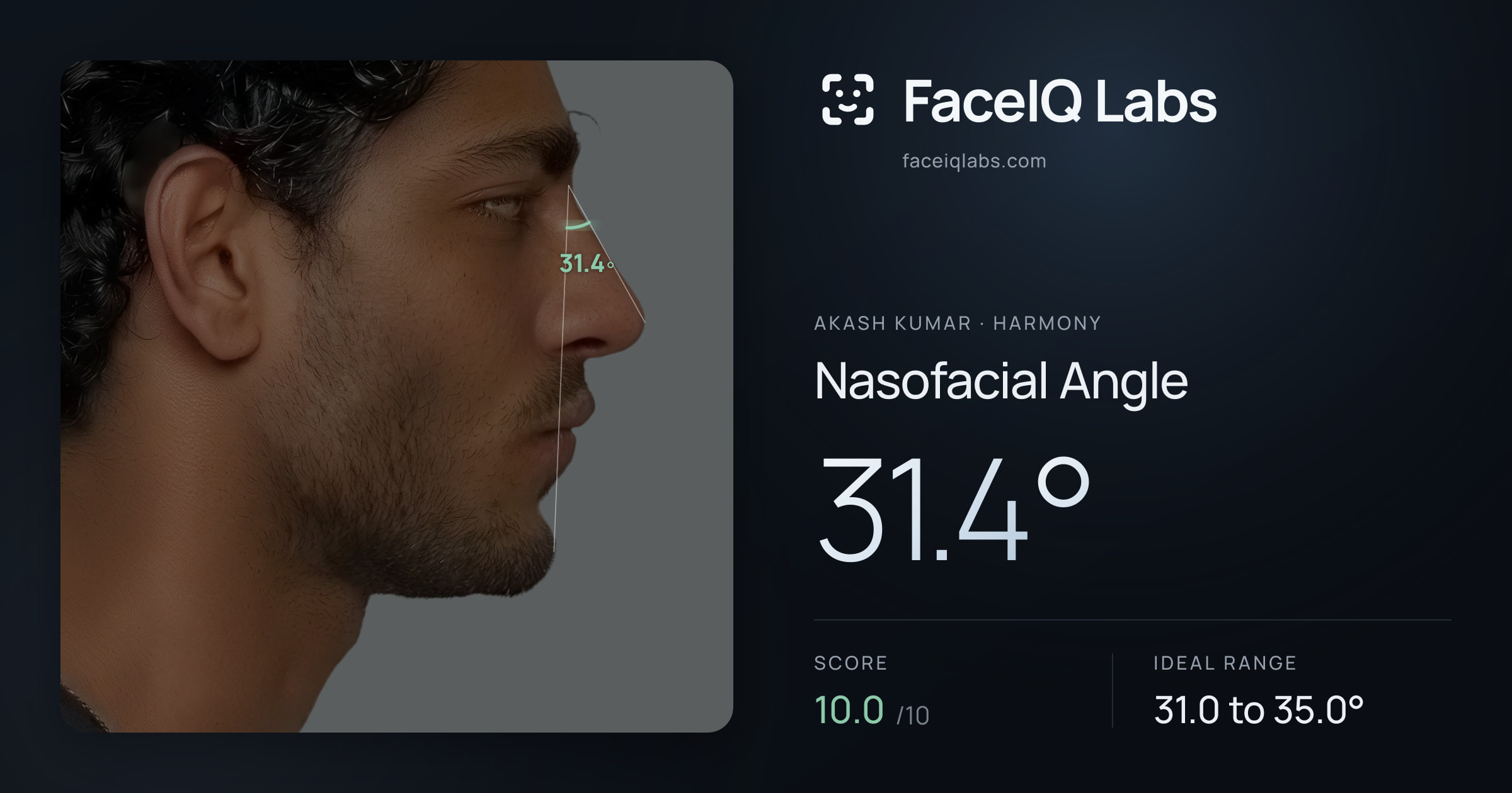 Akash Kumar Nasofacial Angle: 31.4°, drawn on the photo