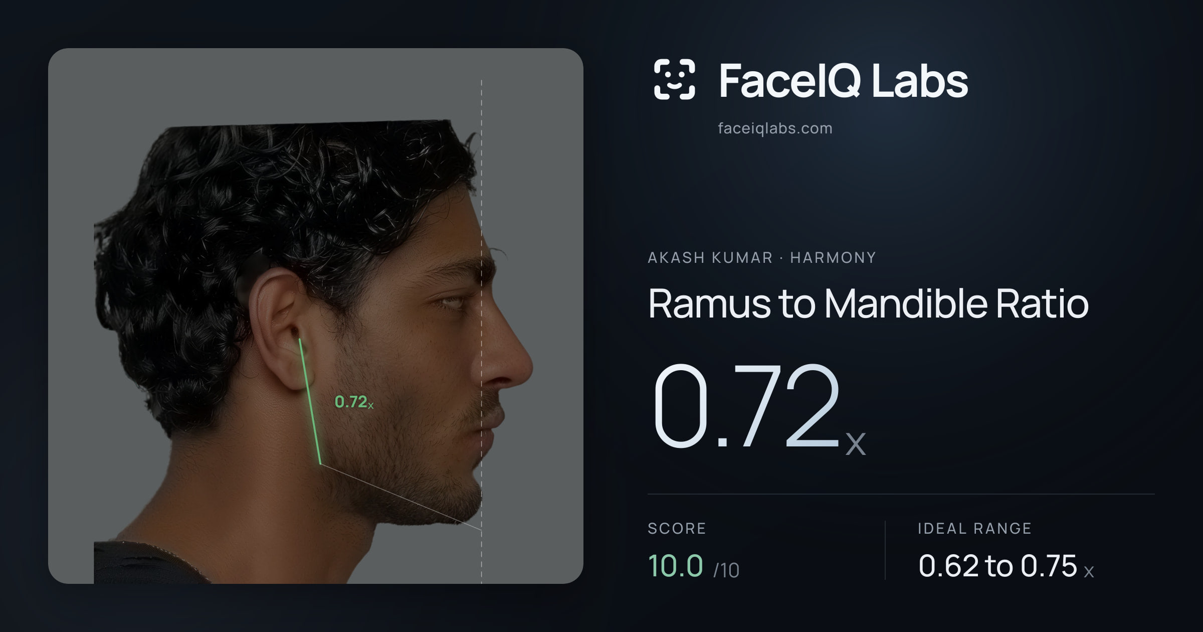 Akash Kumar Ramus to Mandible Ratio: 0.72x, drawn on the photo