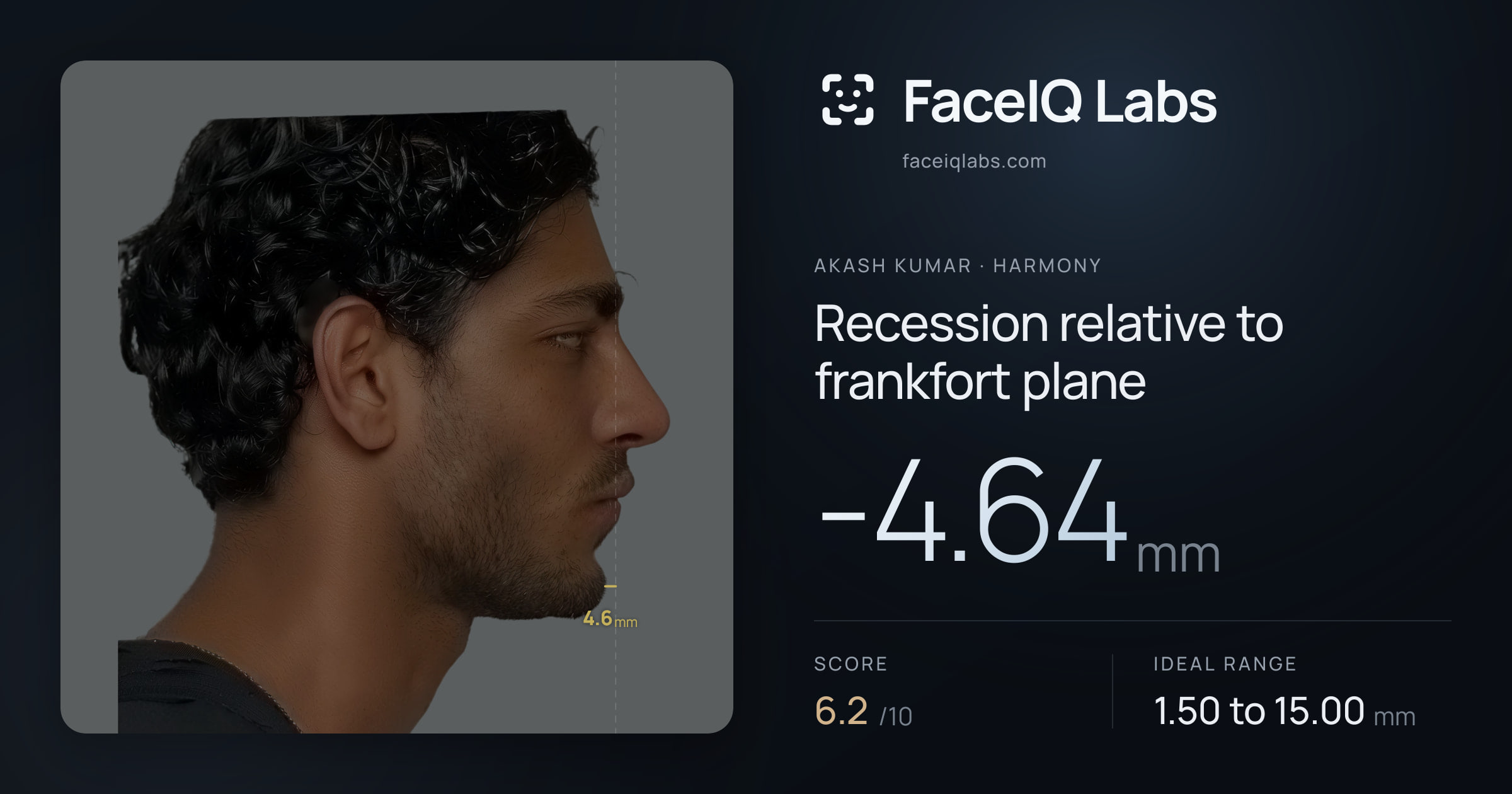 Akash Kumar Recession relative to frankfort plane: -4.64mm, drawn on the photo