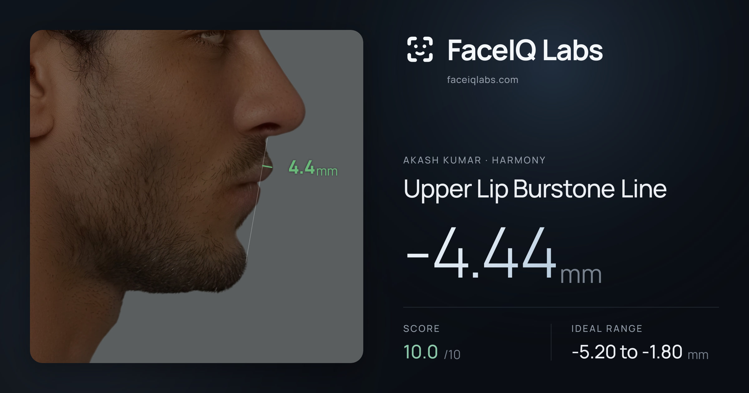 Akash Kumar Upper Lip Burstone Line: -4.44mm, drawn on the photo