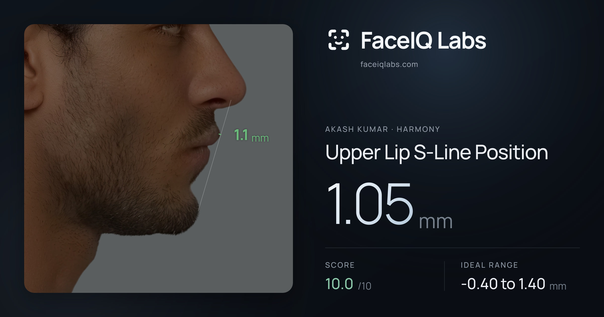 Akash Kumar Upper Lip S-Line Position: 1.05mm, drawn on the photo