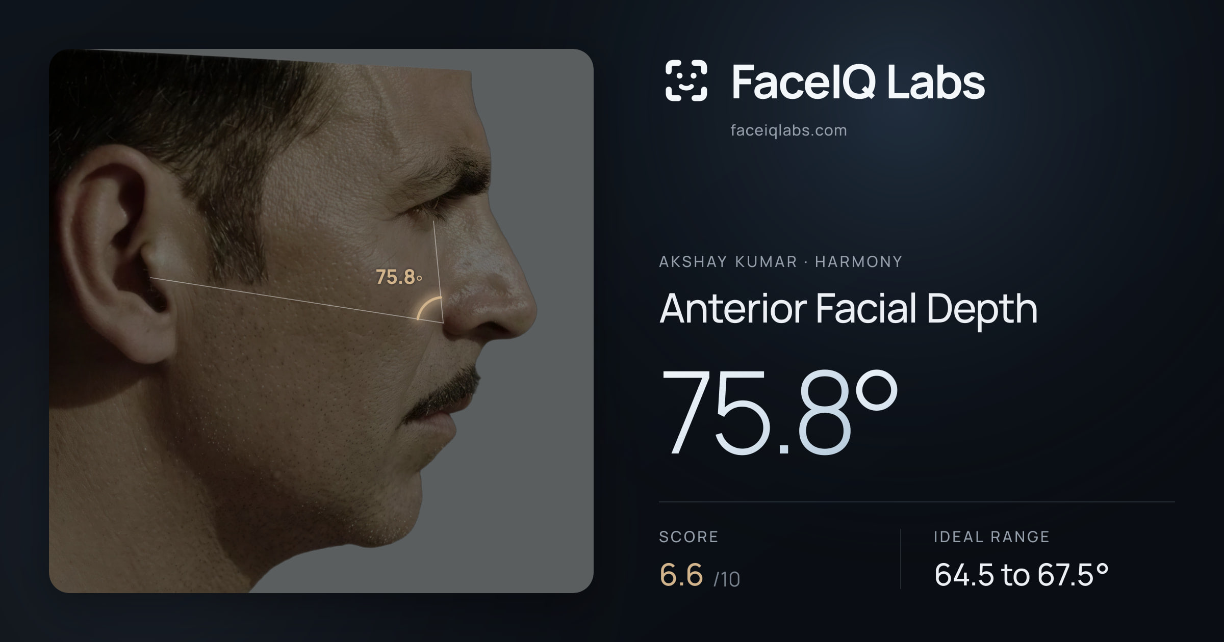 Akshay Kumar Anterior Facial Depth: 75.8°, drawn on the photo