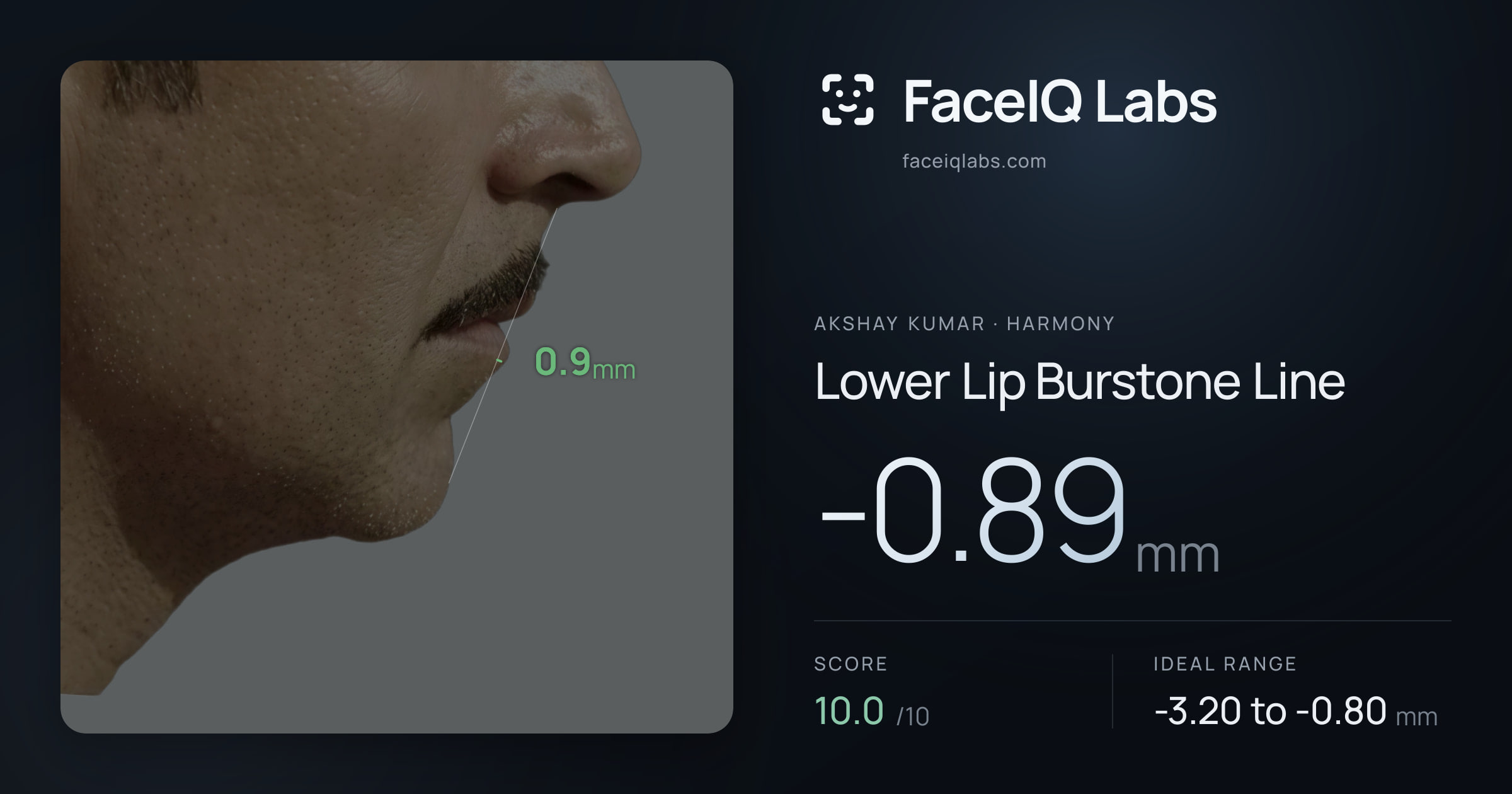 Akshay Kumar Lower Lip Burstone Line: -0.89mm, drawn on the photo