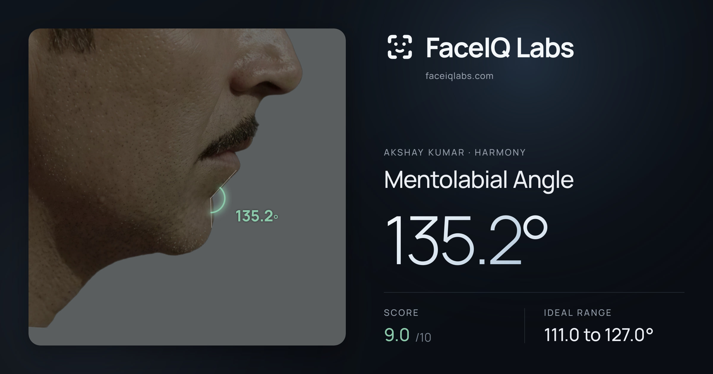 Akshay Kumar Mentolabial Angle: 135.2°, drawn on the photo