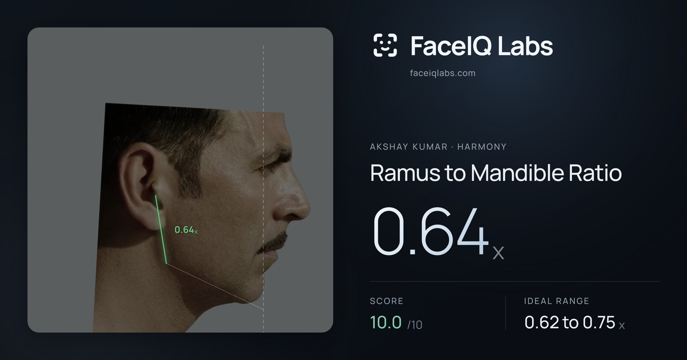 Akshay Kumar Ramus to Mandible Ratio: 0.64x, drawn on the photo