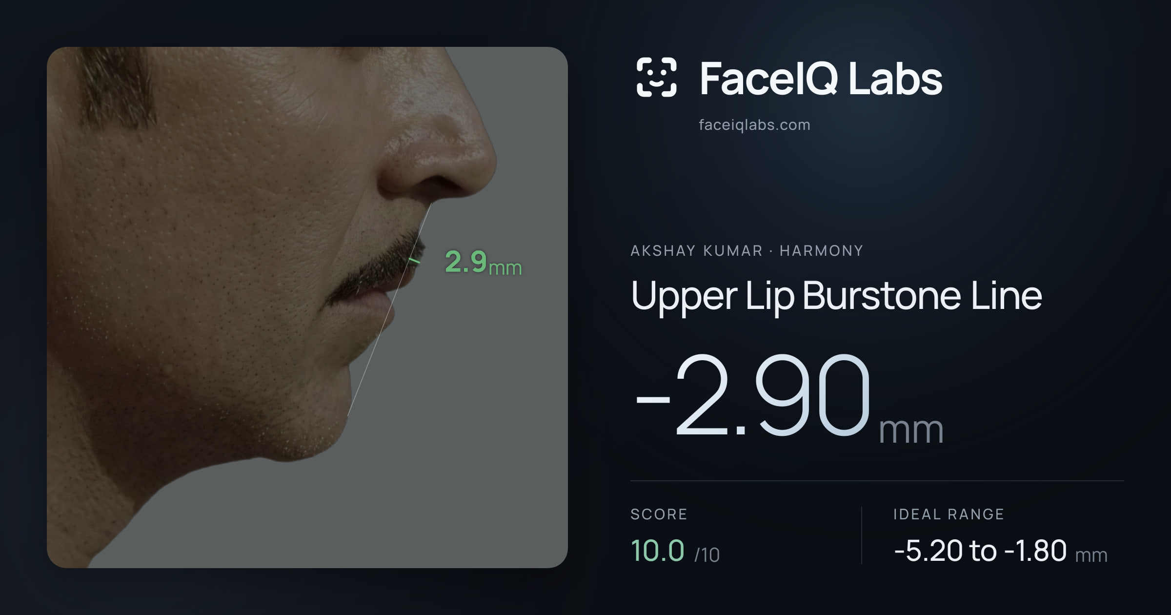 Akshay Kumar Upper Lip Burstone Line: -2.90mm, drawn on the photo