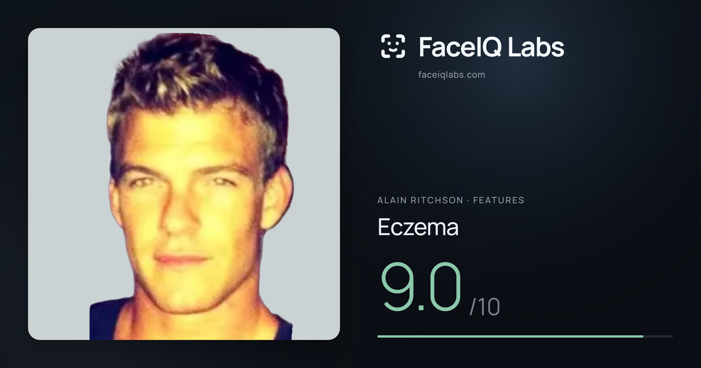 Alain Ritchson Eczema: 9.0/10, drawn on the photo