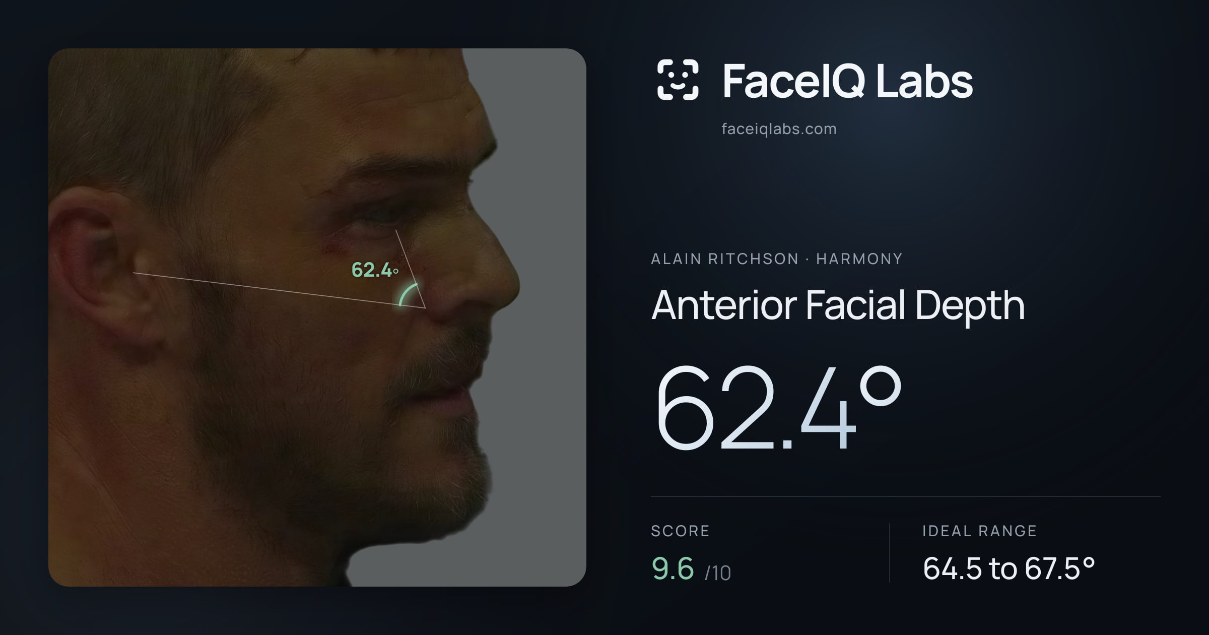 Alain Ritchson Anterior Facial Depth: 62.4°, drawn on the photo