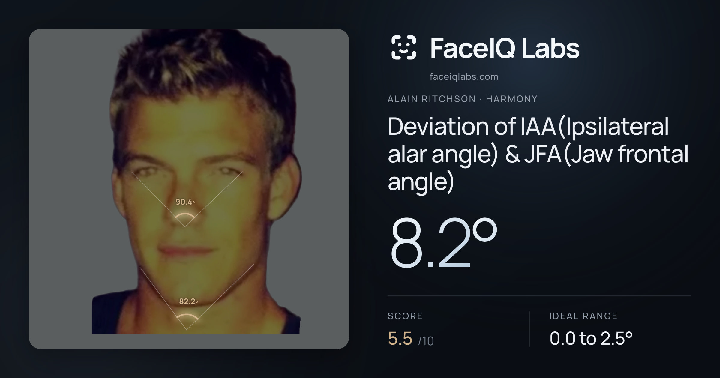 Alain Ritchson Deviation of IAA(Ipsilateral alar angle) & JFA(Jaw frontal angle): 8.2°, drawn on the photo