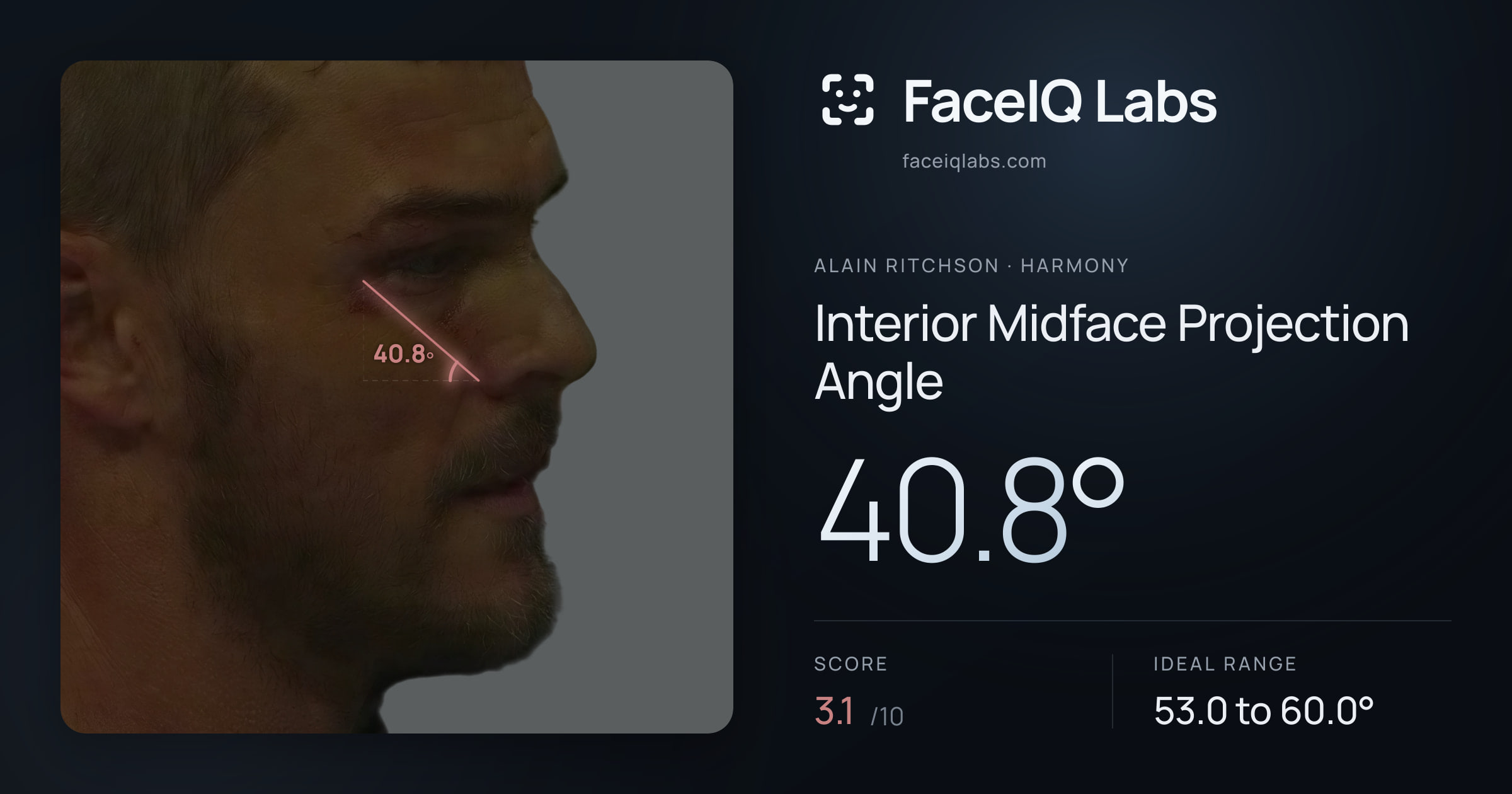 Alain Ritchson Interior Midface Projection Angle: 40.8°, drawn on the photo