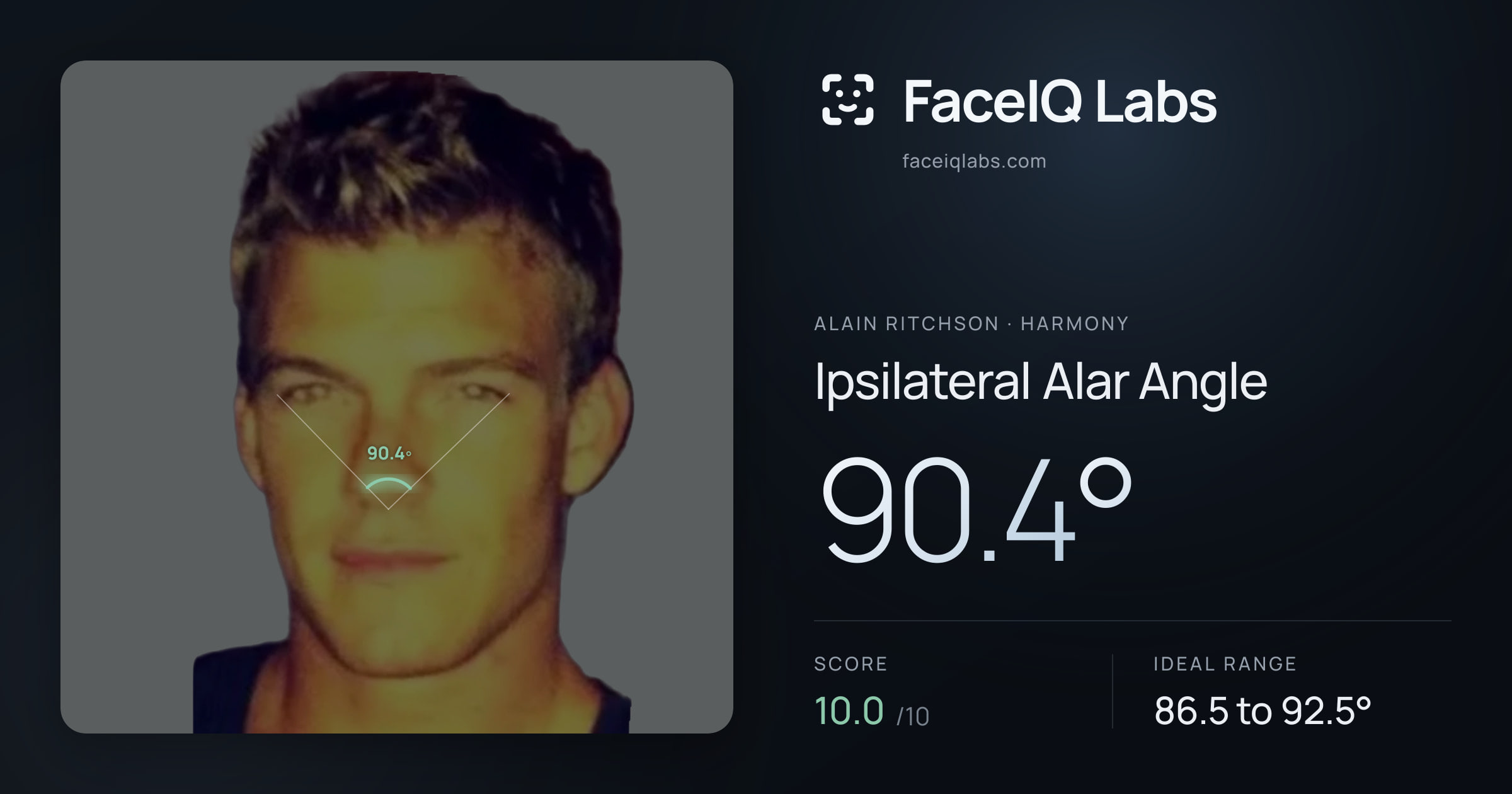 Alain Ritchson Ipsilateral Alar Angle: 90.4°, drawn on the photo