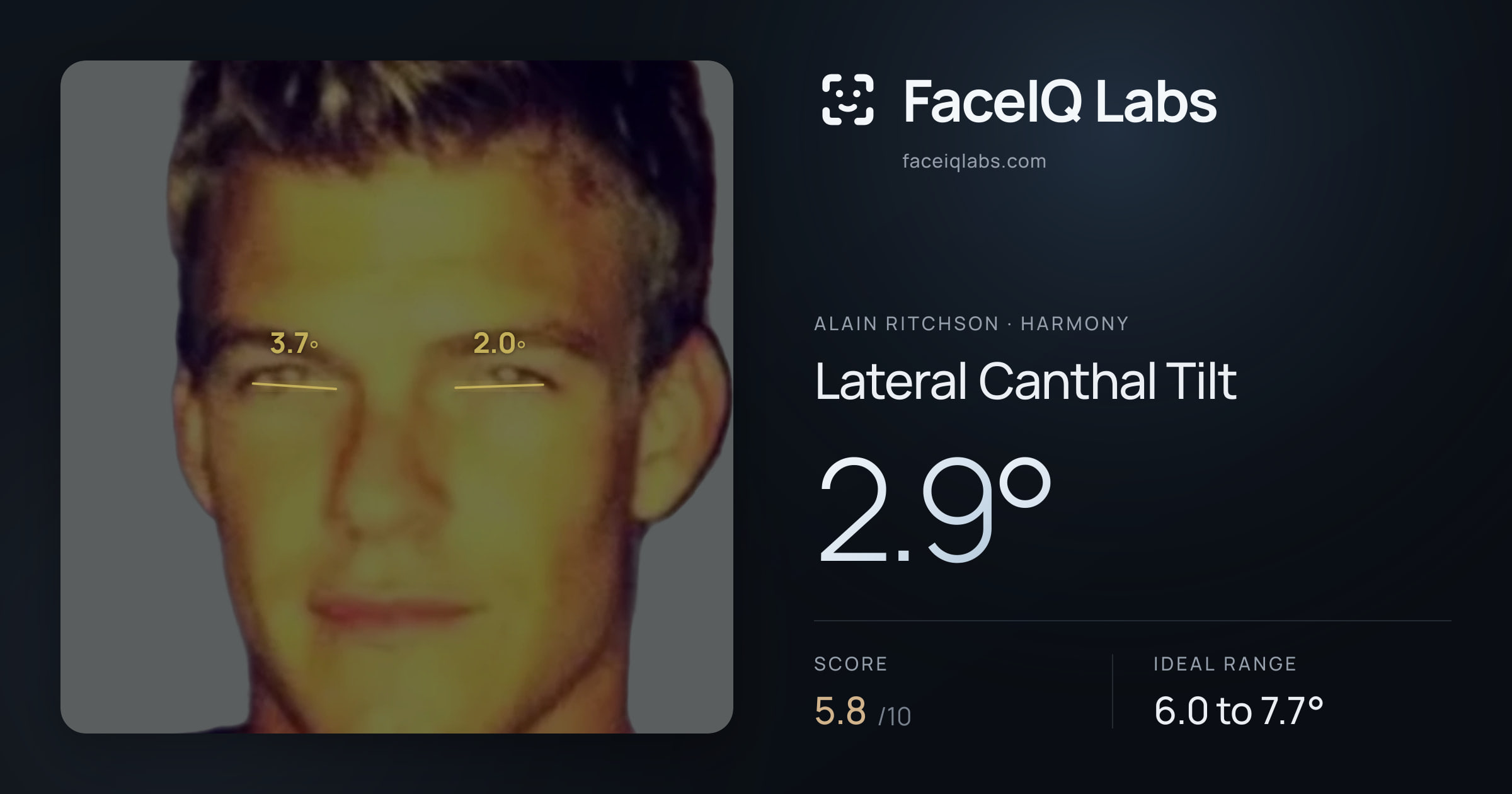 Alain Ritchson Lateral Canthal Tilt: 2.9°, drawn on the photo