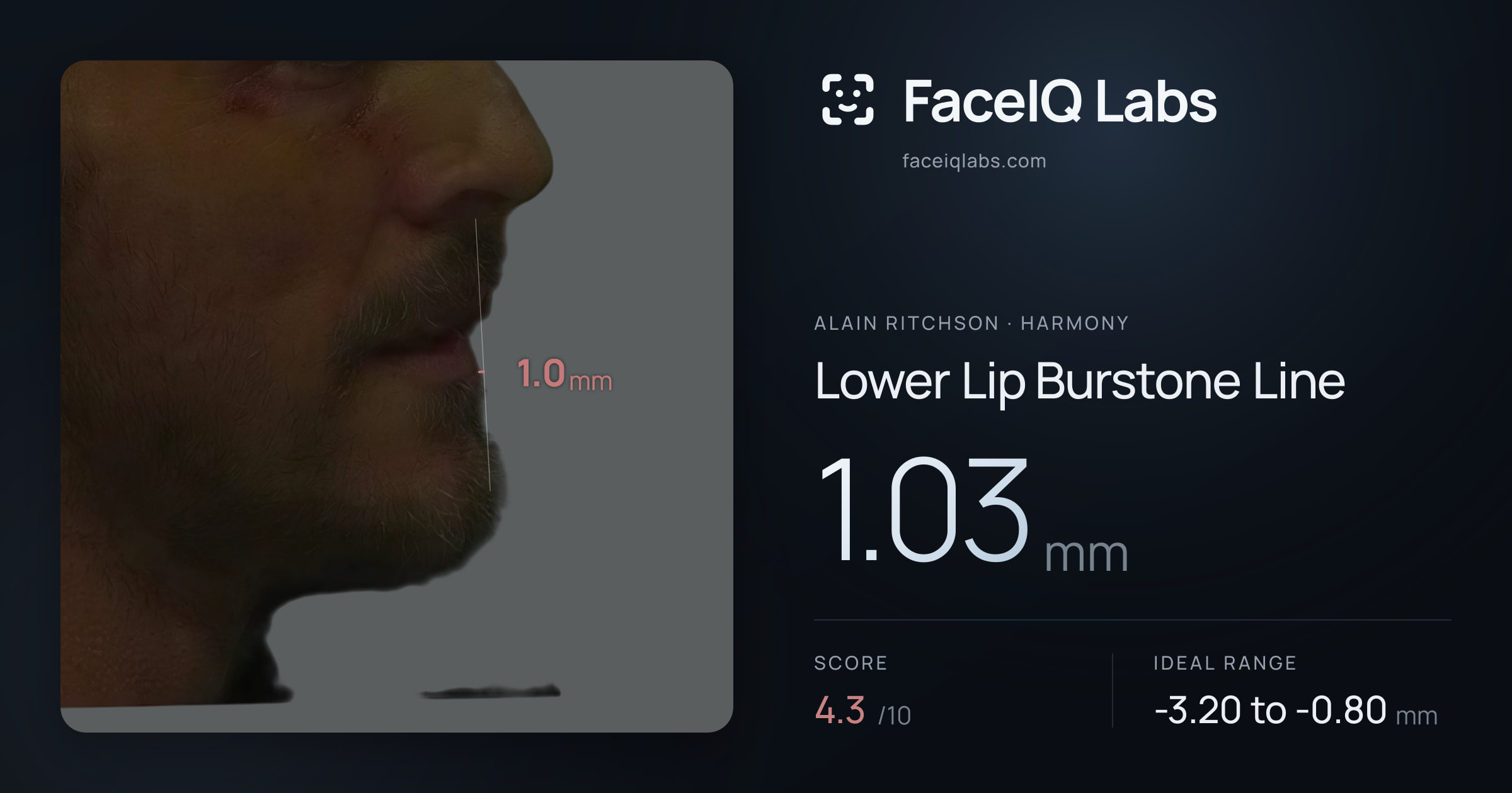Alain Ritchson Lower Lip Burstone Line: 1.03mm, drawn on the photo