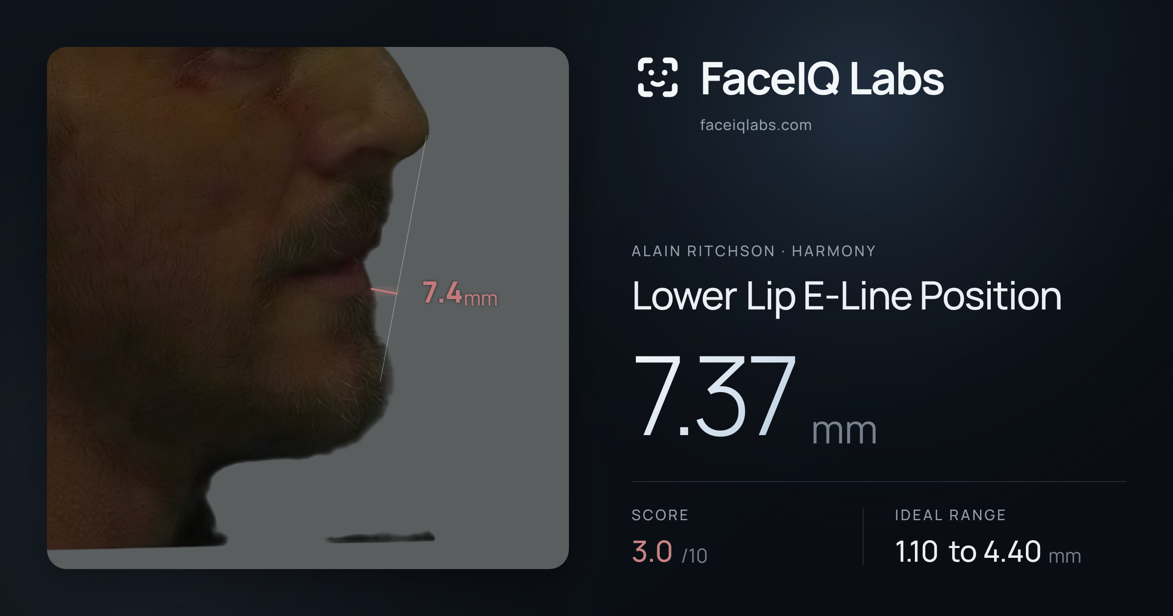 Alain Ritchson Lower Lip E-Line Position: 7.37mm, drawn on the photo