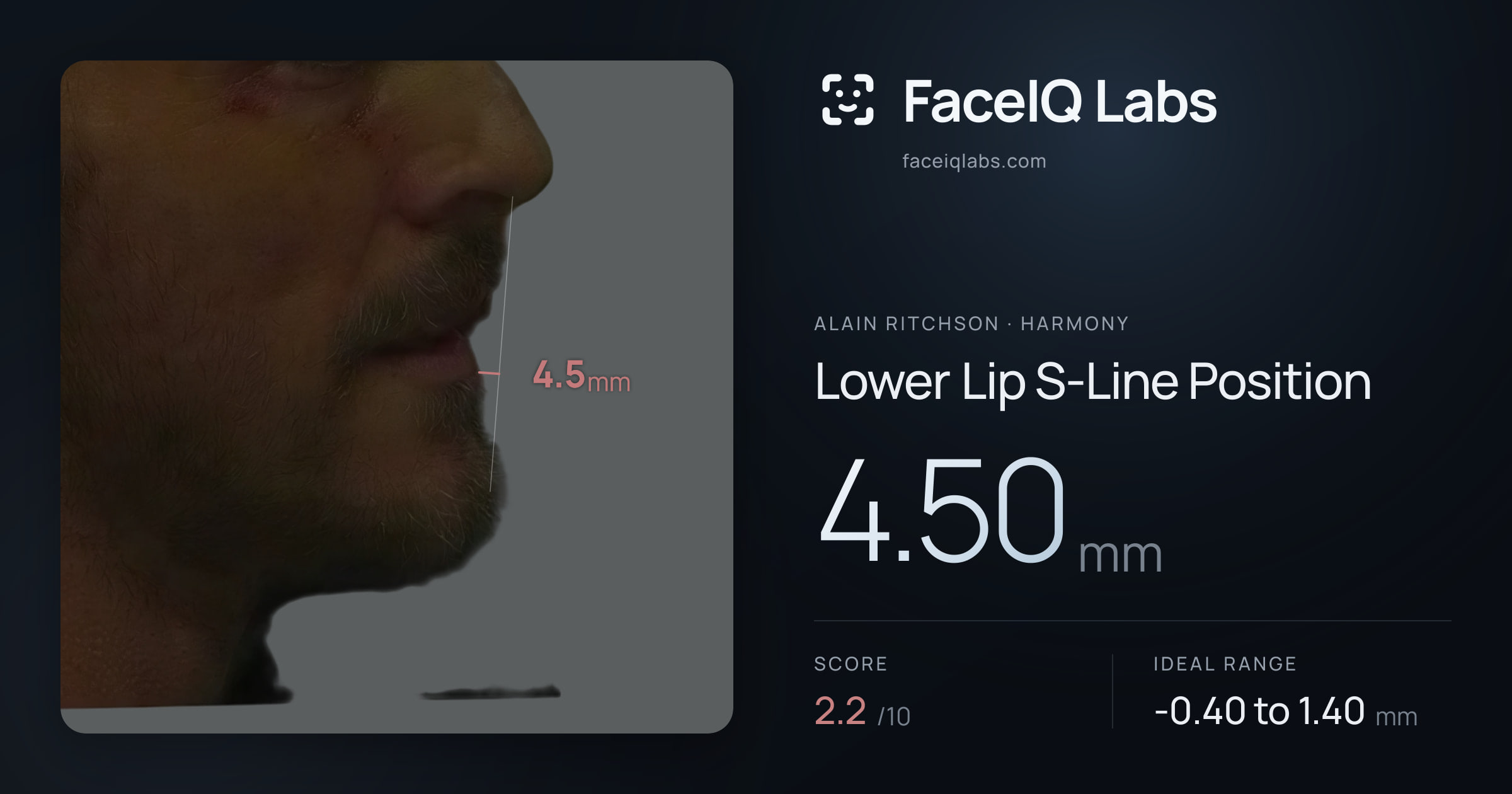Alain Ritchson Lower Lip S-Line Position: 4.50mm, drawn on the photo