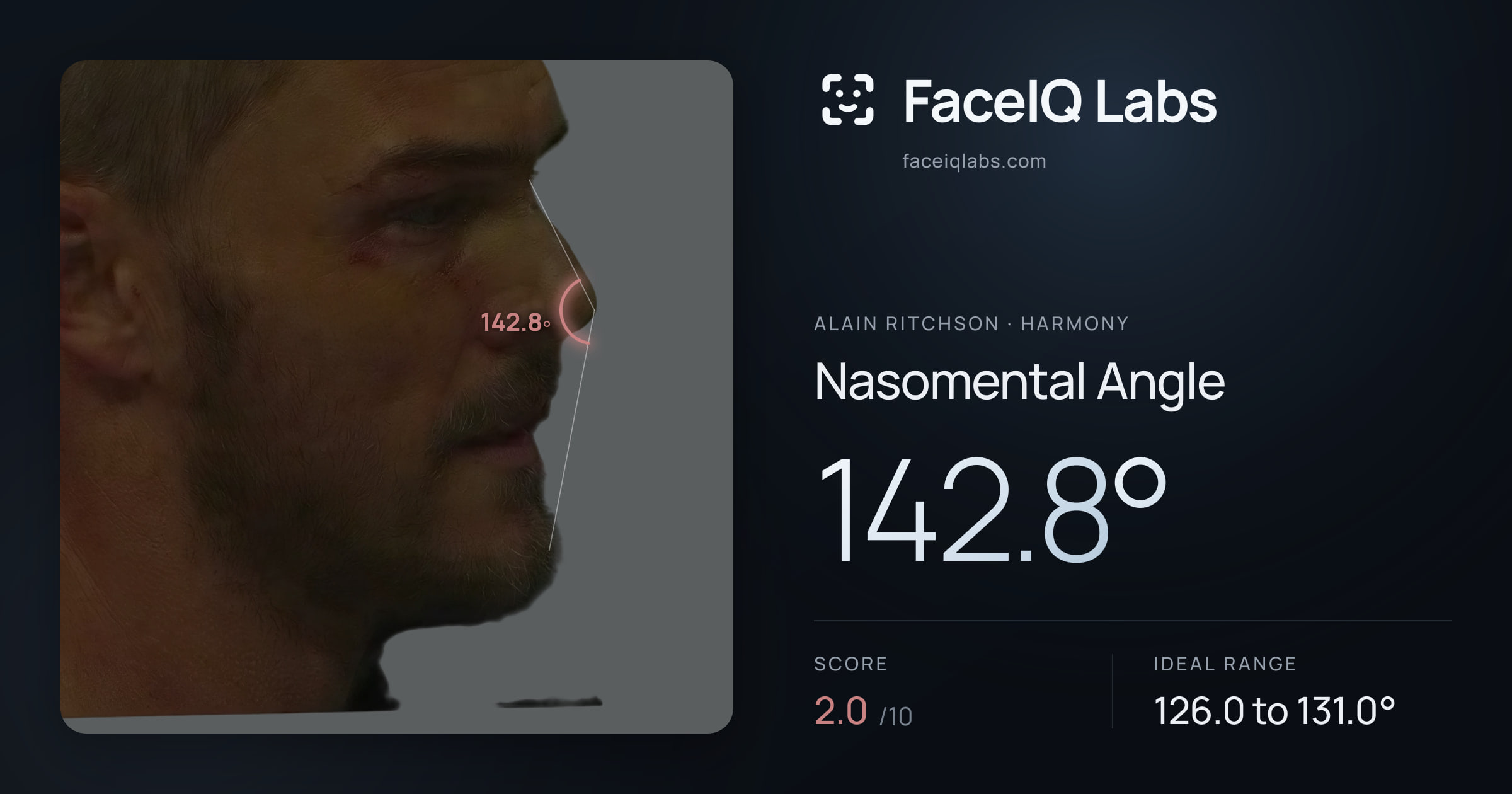 Alain Ritchson Nasomental Angle: 142.8°, drawn on the photo