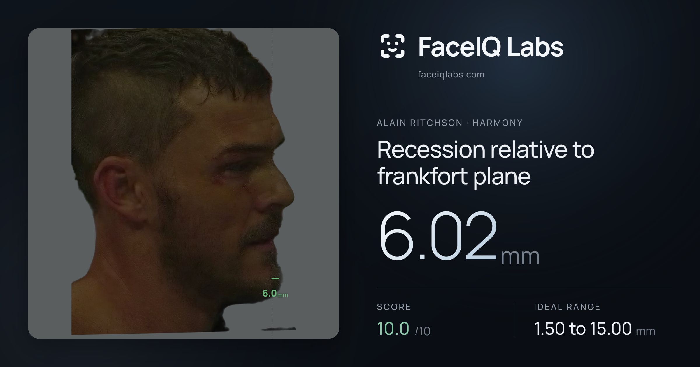 Alain Ritchson Recession relative to frankfort plane: 6.02mm, drawn on the photo