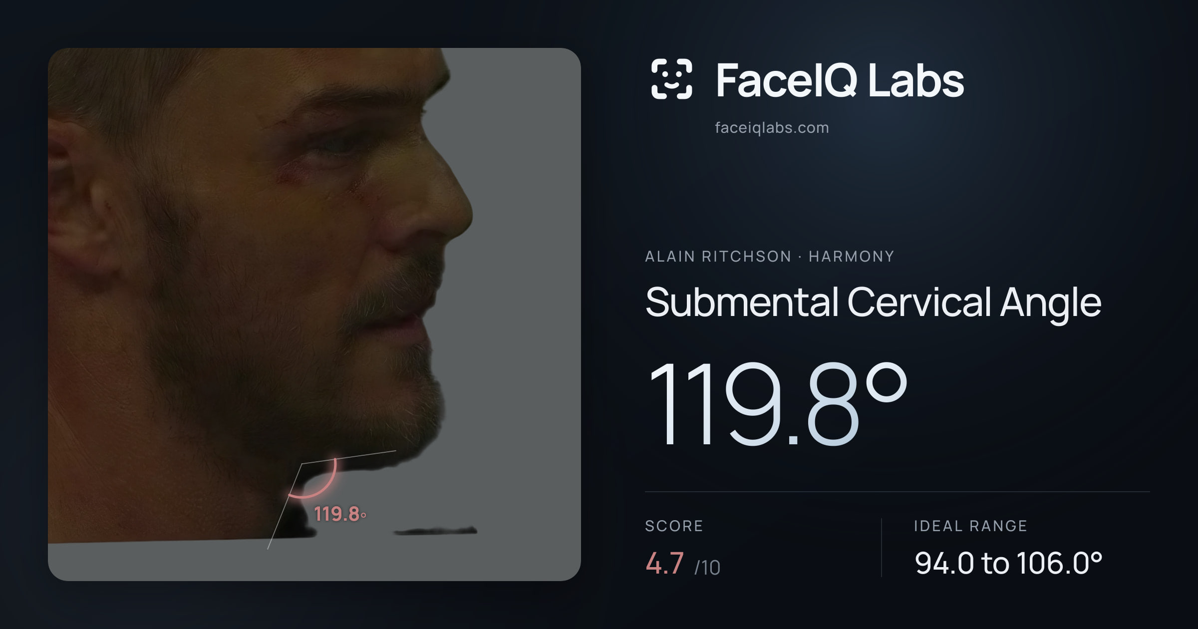 Alain Ritchson Submental Cervical Angle: 119.8°, drawn on the photo