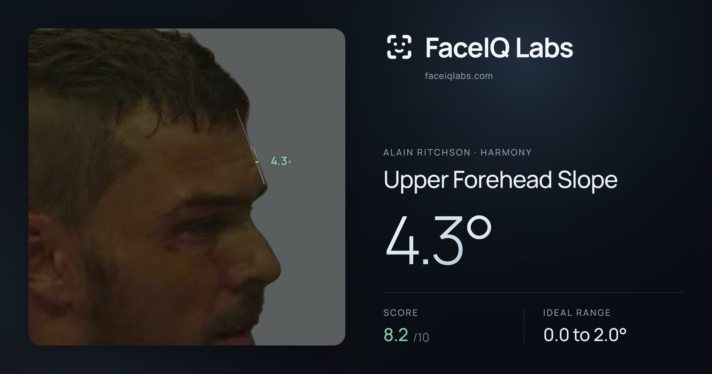 Alain Ritchson Upper Forehead Slope: 4.3°, drawn on the photo