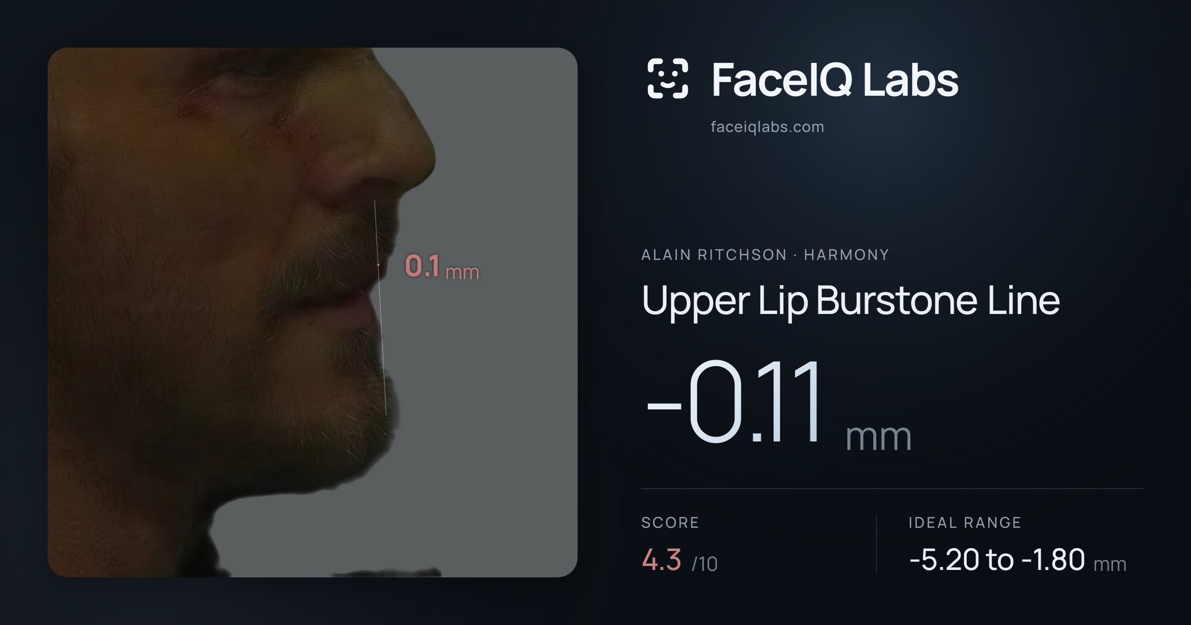 Alain Ritchson Upper Lip Burstone Line: -0.11mm, drawn on the photo