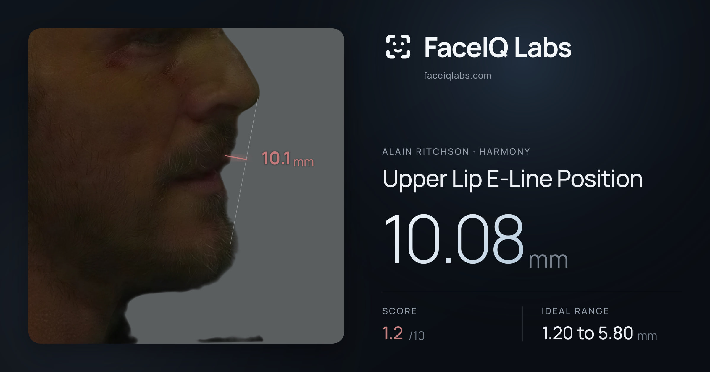 Alain Ritchson Upper Lip E-Line Position: 10.08mm, drawn on the photo