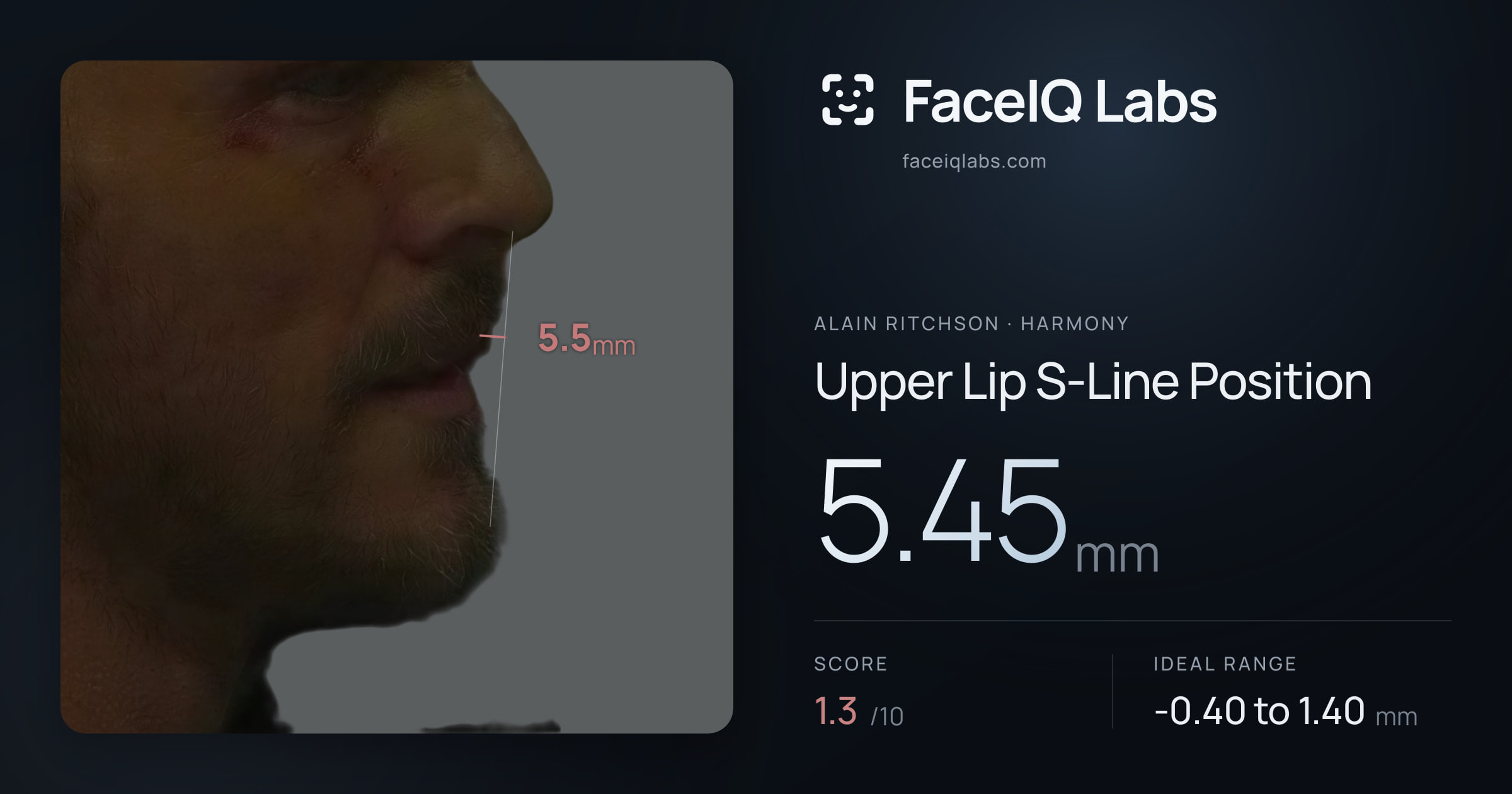 Alain Ritchson Upper Lip S-Line Position: 5.45mm, drawn on the photo