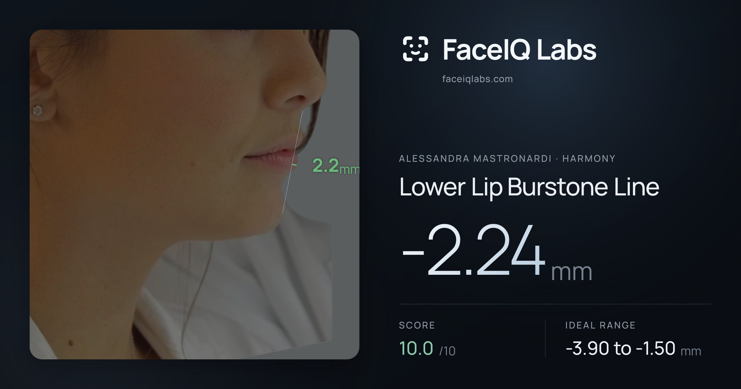 Alessandra Mastronardi Lower Lip Burstone Line: -2.24mm, drawn on the photo