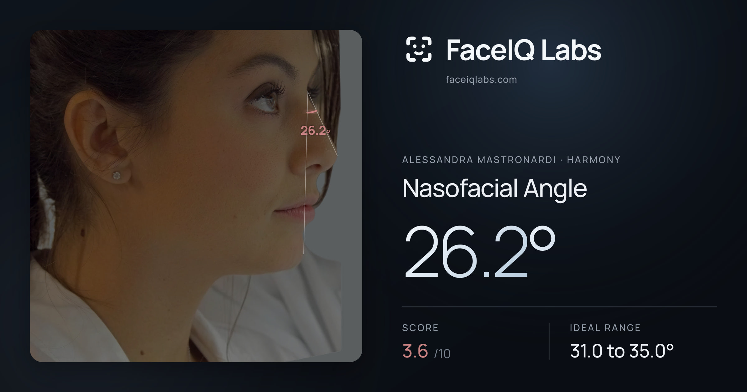 Alessandra Mastronardi Nasofacial Angle: 26.2°, drawn on the photo