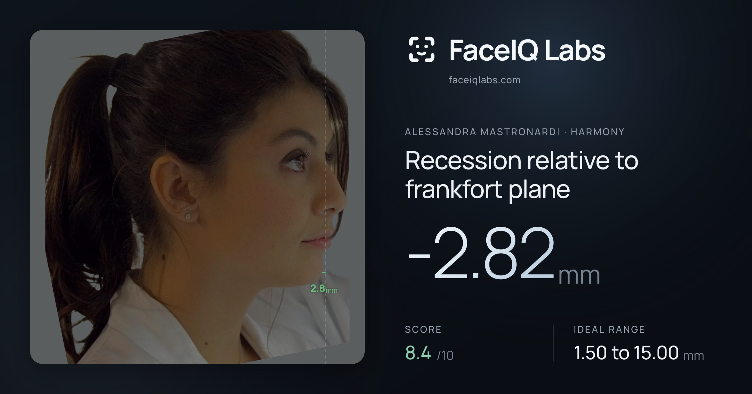 Alessandra Mastronardi Recession relative to frankfort plane: -2.82mm, drawn on the photo