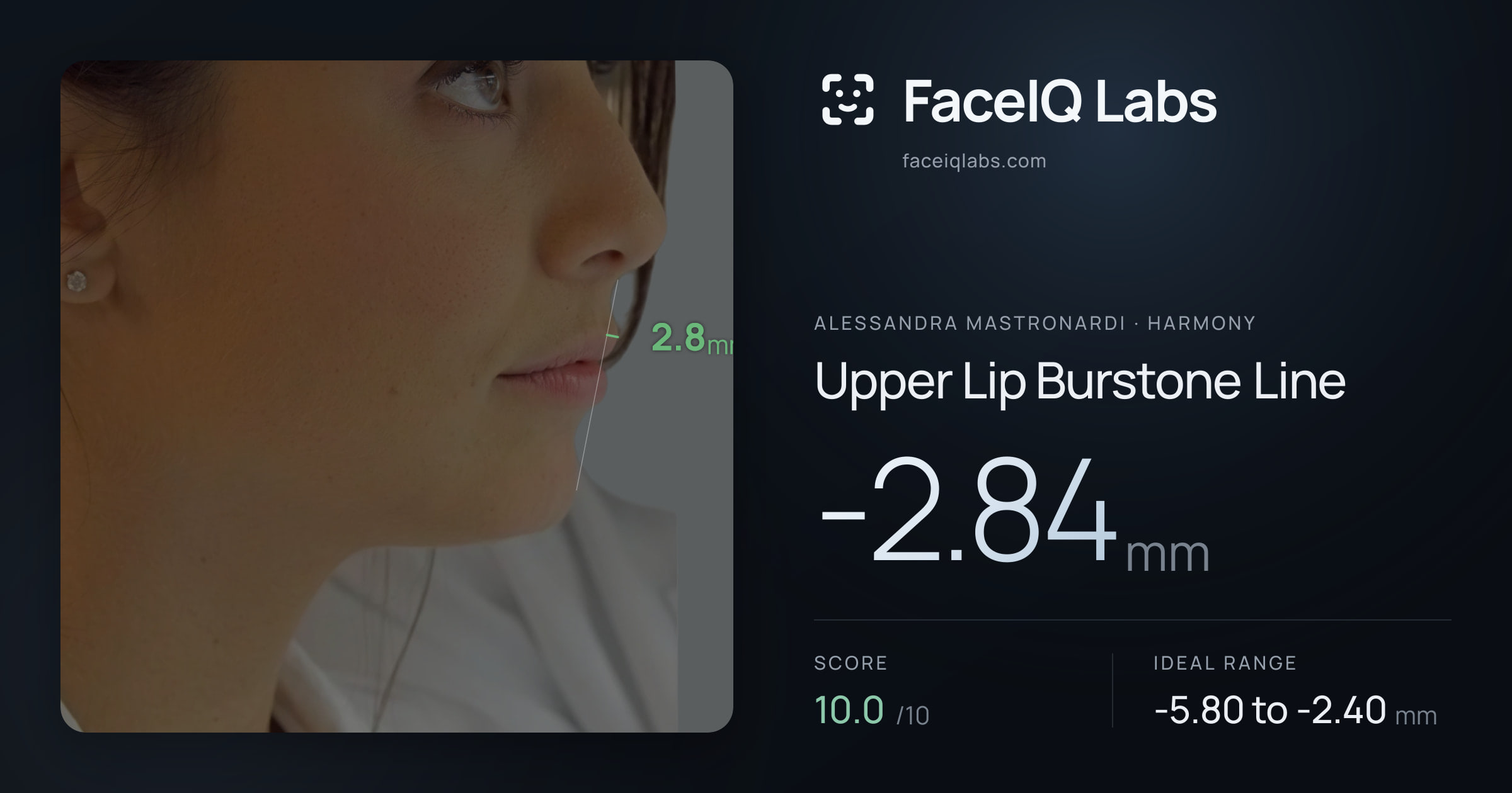Alessandra Mastronardi Upper Lip Burstone Line: -2.84mm, drawn on the photo