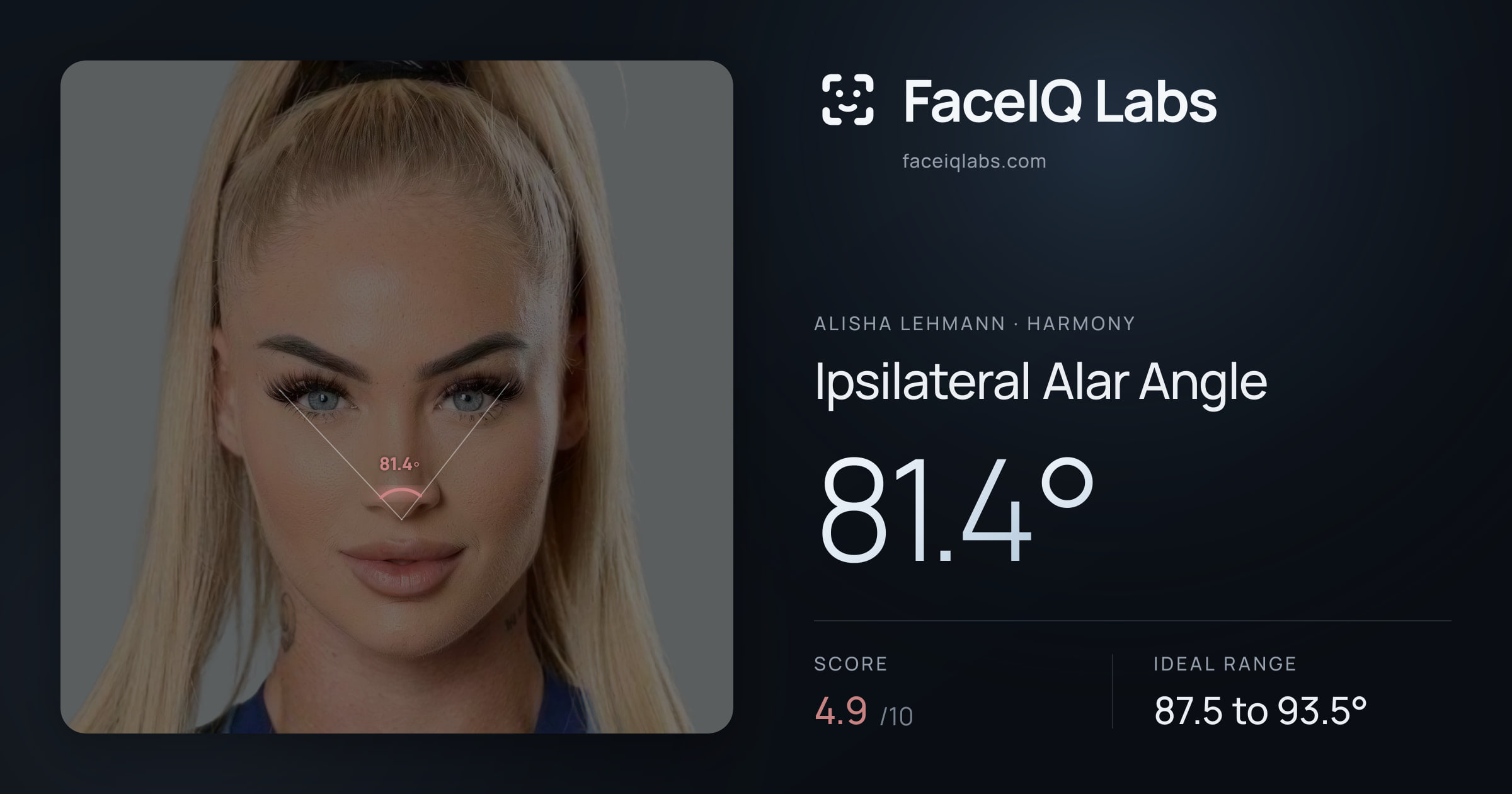 Alisha Lehmann Ipsilateral Alar Angle: 81.4°, drawn on the photo